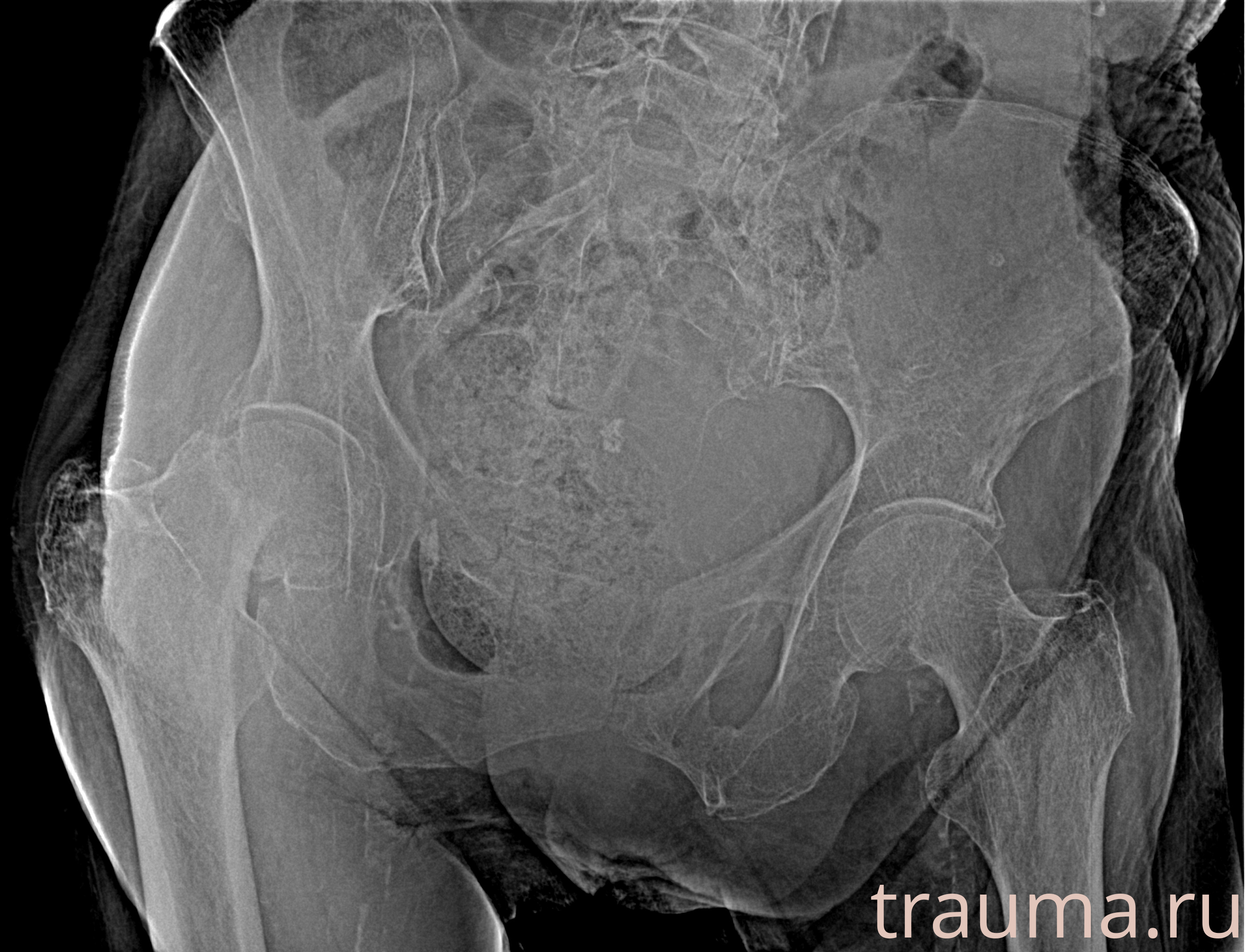 Рентген на дому: по вашему адресу приезжает врач-рентгенолог, травматолог-ортопед с мобильным рентгеновским аппаратом, проводит диагностику травмы или заболевания, делает необходимые рентгенограммы, дает рекомендации по дальнейшему лечению. Получить качественные снимки в домашних условиях возможно благодаря уникальной методике, разработанной МосРентген Центром для института  Склифосовского