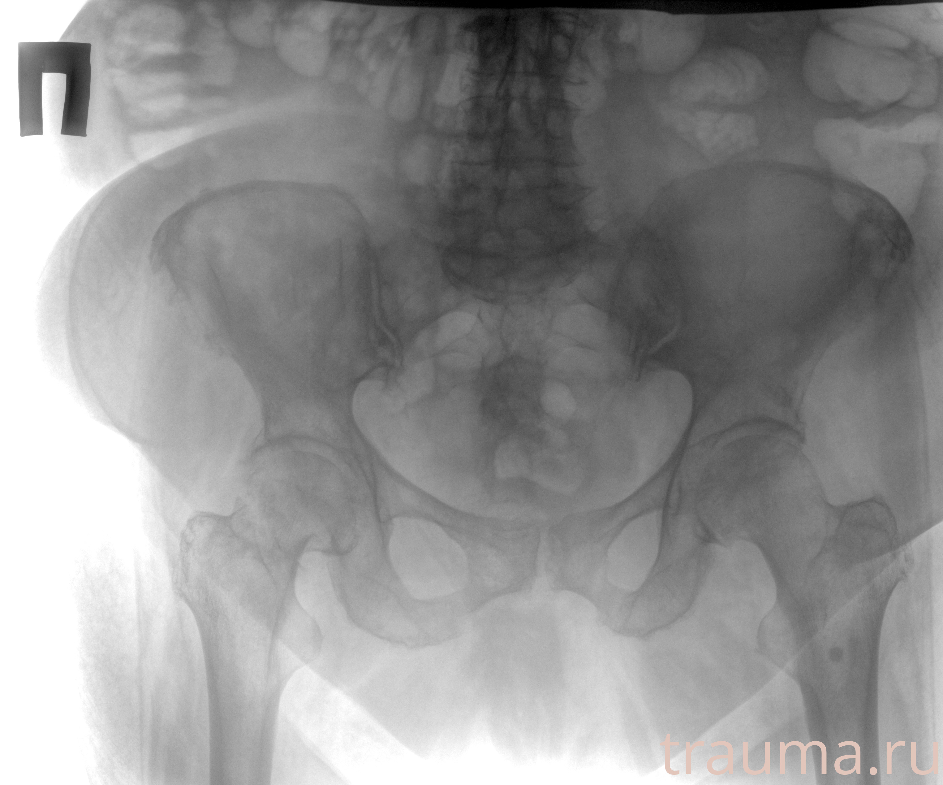 Рентген на дому: по вашему адресу приезжает врач-рентгенолог, травматолог-ортопед с мобильным рентгеновским аппаратом, проводит диагностику травмы или заболевания, делает необходимые рентгенограммы, дает рекомендации по дальнейшему лечению. Получить качественные снимки в домашних условиях возможно благодаря уникальной методике, разработанной МосРентген Центром для института  Склифосовского