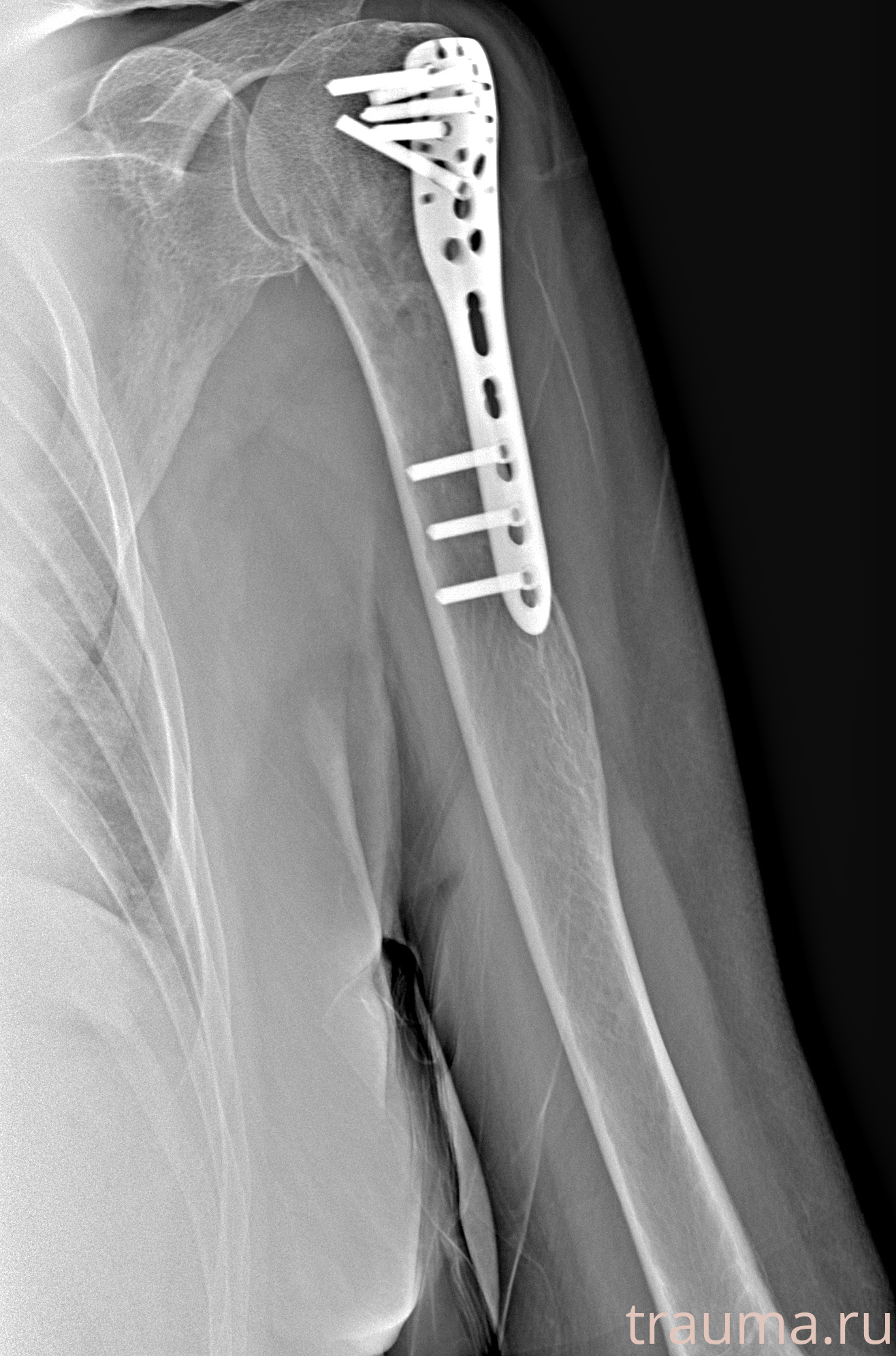 Рентген на дому: по вашему адресу приезжает врач-рентгенолог, травматолог-ортопед с мобильным рентгеновским аппаратом, проводит диагностику травмы или заболевания, делает необходимые рентгенограммы, дает рекомендации по дальнейшему лечению. Получить качественные снимки в домашних условиях возможно благодаря уникальной методике, разработанной МосРентген Центром для института  Склифосовского