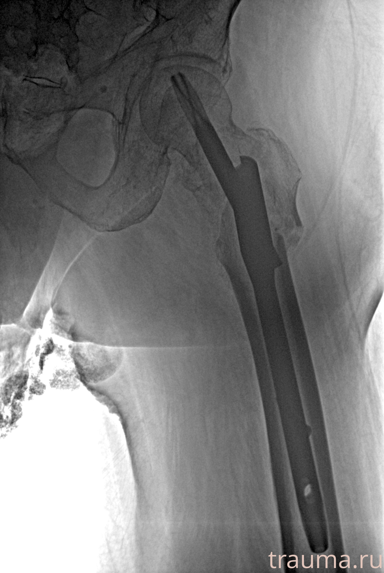 Рентген на дому: по вашему адресу приезжает врач-рентгенолог, травматолог-ортопед с мобильным рентгеновским аппаратом, проводит диагностику травмы или заболевания, делает необходимые рентгенограммы, дает рекомендации по дальнейшему лечению. Получить качественные снимки в домашних условиях возможно благодаря уникальной методике, разработанной МосРентген Центром для института  Склифосовского