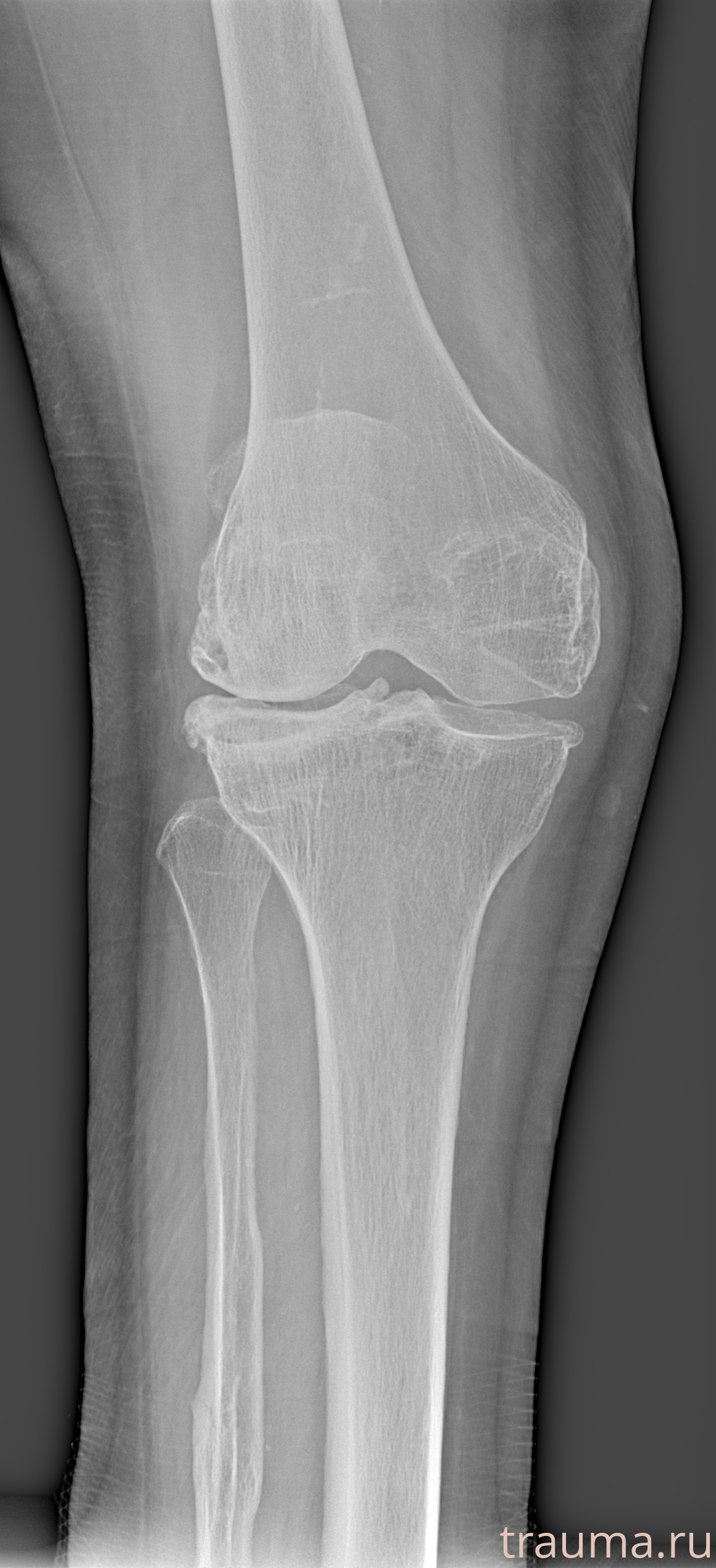Рентген на дому: по вашему адресу приезжает врач-рентгенолог, травматолог-ортопед с мобильным рентгеновским аппаратом, проводит диагностику травмы или заболевания, делает необходимые рентгенограммы, дает рекомендации по дальнейшему лечению. Получить качественные снимки в домашних условиях возможно благодаря уникальной методике, разработанной МосРентген Центром для института  Склифосовского