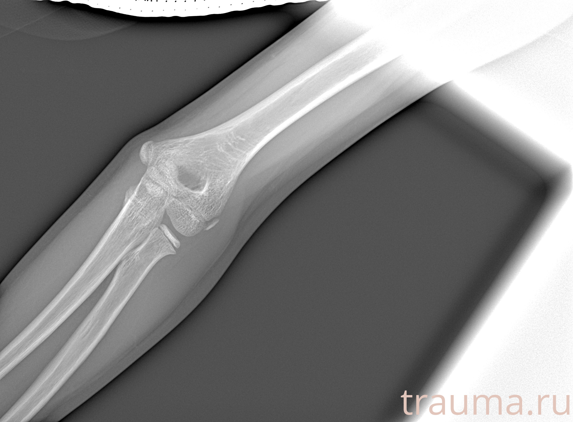 Рентген на дому: по вашему адресу приезжает врач-рентгенолог, травматолог-ортопед с мобильным рентгеновским аппаратом, проводит диагностику травмы или заболевания, делает необходимые рентгенограммы, дает рекомендации по дальнейшему лечению. Получить качественные снимки в домашних условиях возможно благодаря уникальной методике, разработанной МосРентген Центром для института  Склифосовского