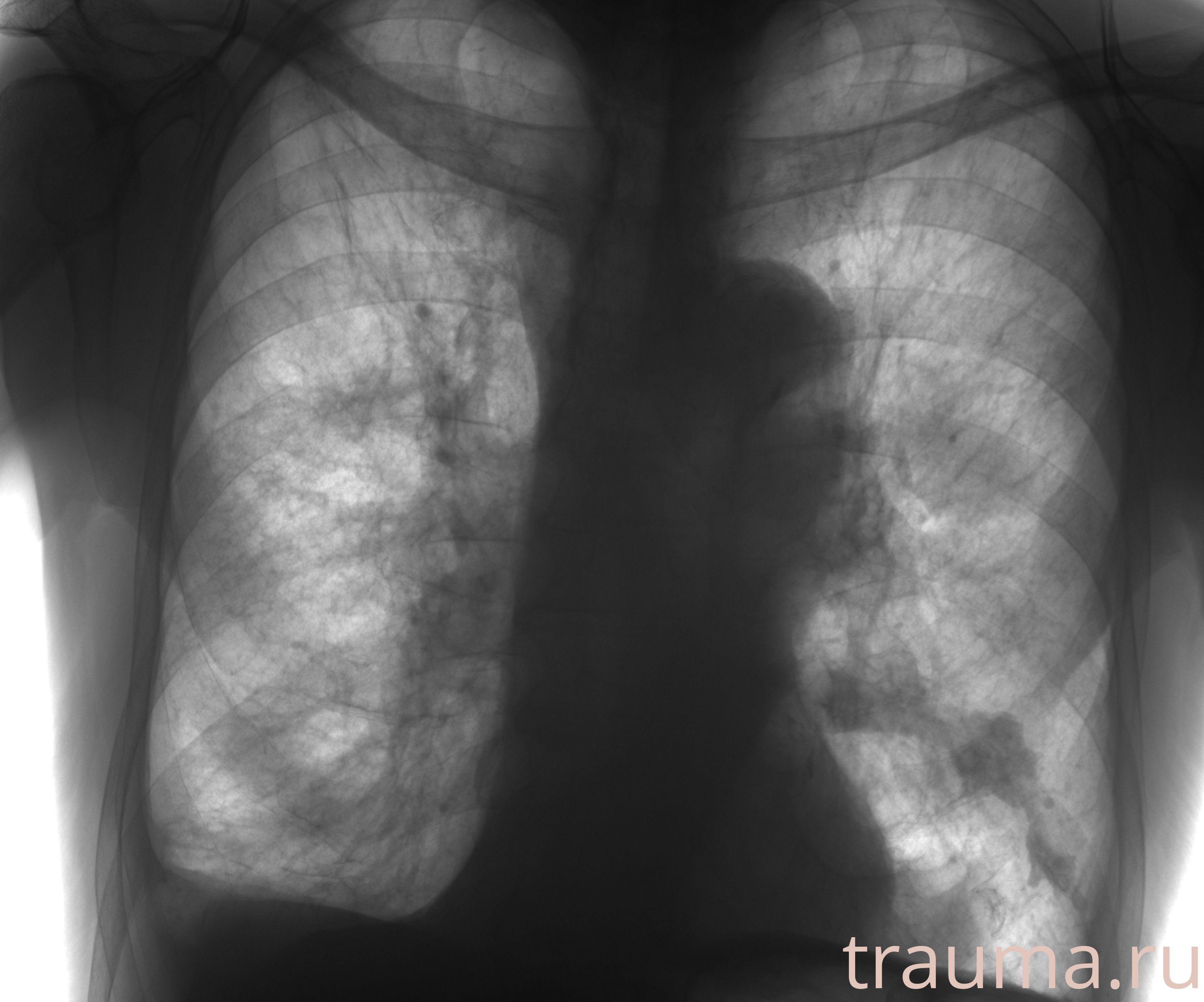 Рентген на дому: по вашему адресу приезжает врач-рентгенолог, травматолог-ортопед с мобильным рентгеновским аппаратом, проводит диагностику травмы или заболевания, делает необходимые рентгенограммы, дает рекомендации по дальнейшему лечению. Получить качественные снимки в домашних условиях возможно благодаря уникальной методике, разработанной МосРентген Центром для института  Склифосовского