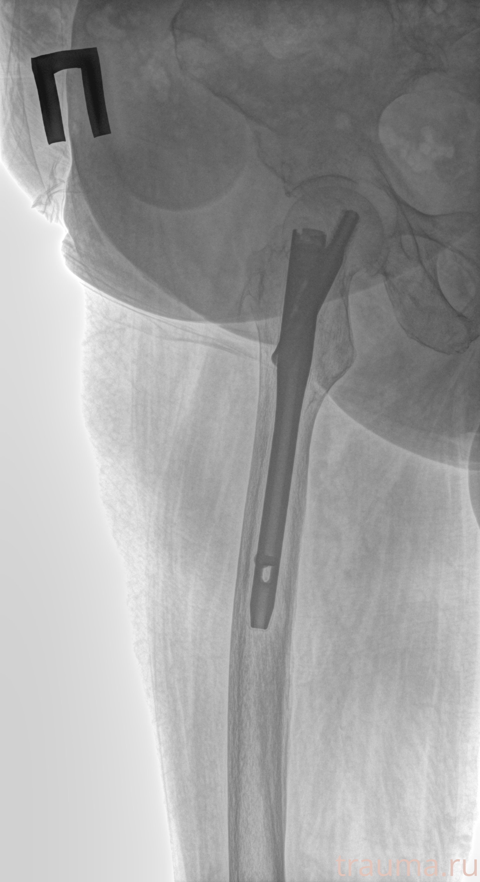 Рентген на дому: по вашему адресу приезжает врач-рентгенолог, травматолог-ортопед с мобильным рентгеновским аппаратом, проводит диагностику травмы или заболевания, делает необходимые рентгенограммы, дает рекомендации по дальнейшему лечению. Получить качественные снимки в домашних условиях возможно благодаря уникальной методике, разработанной МосРентген Центром для института  Склифосовского