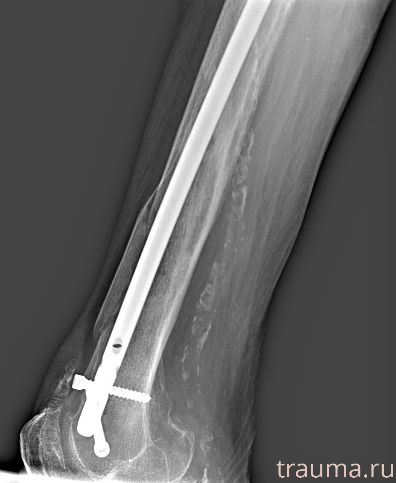Рентген на дому: по вашему адресу приезжает врач-рентгенолог, травматолог-ортопед с мобильным рентгеновским аппаратом, проводит диагностику травмы или заболевания, делает необходимые рентгенограммы, дает рекомендации по дальнейшему лечению. Получить качественные снимки в домашних условиях возможно благодаря уникальной методике, разработанной МосРентген Центром для института  Склифосовского
