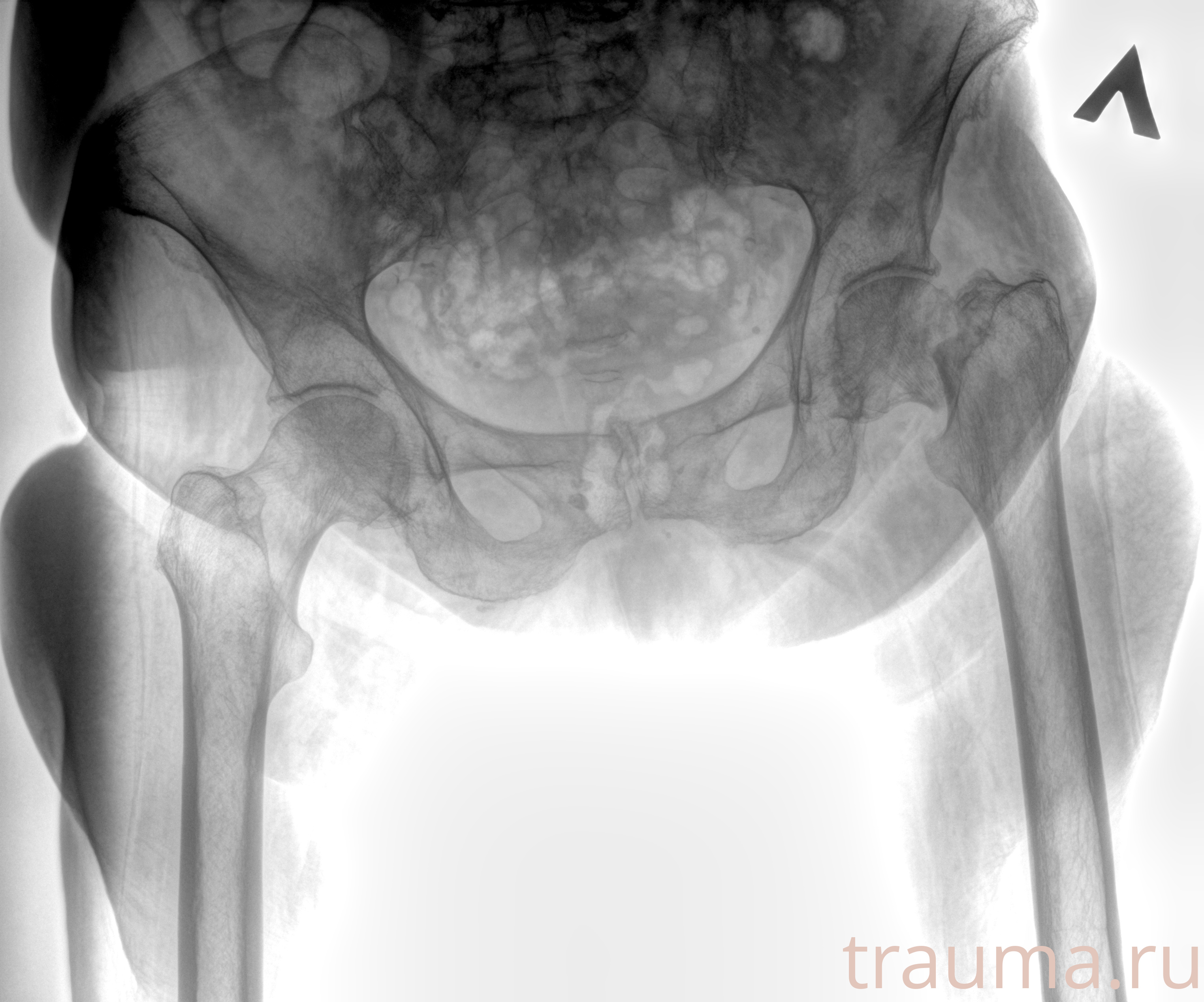 Рентген на дому: по вашему адресу приезжает врач-рентгенолог, травматолог-ортопед с мобильным рентгеновским аппаратом, проводит диагностику травмы или заболевания, делает необходимые рентгенограммы, дает рекомендации по дальнейшему лечению. Получить качественные снимки в домашних условиях возможно благодаря уникальной методике, разработанной МосРентген Центром для института  Склифосовского