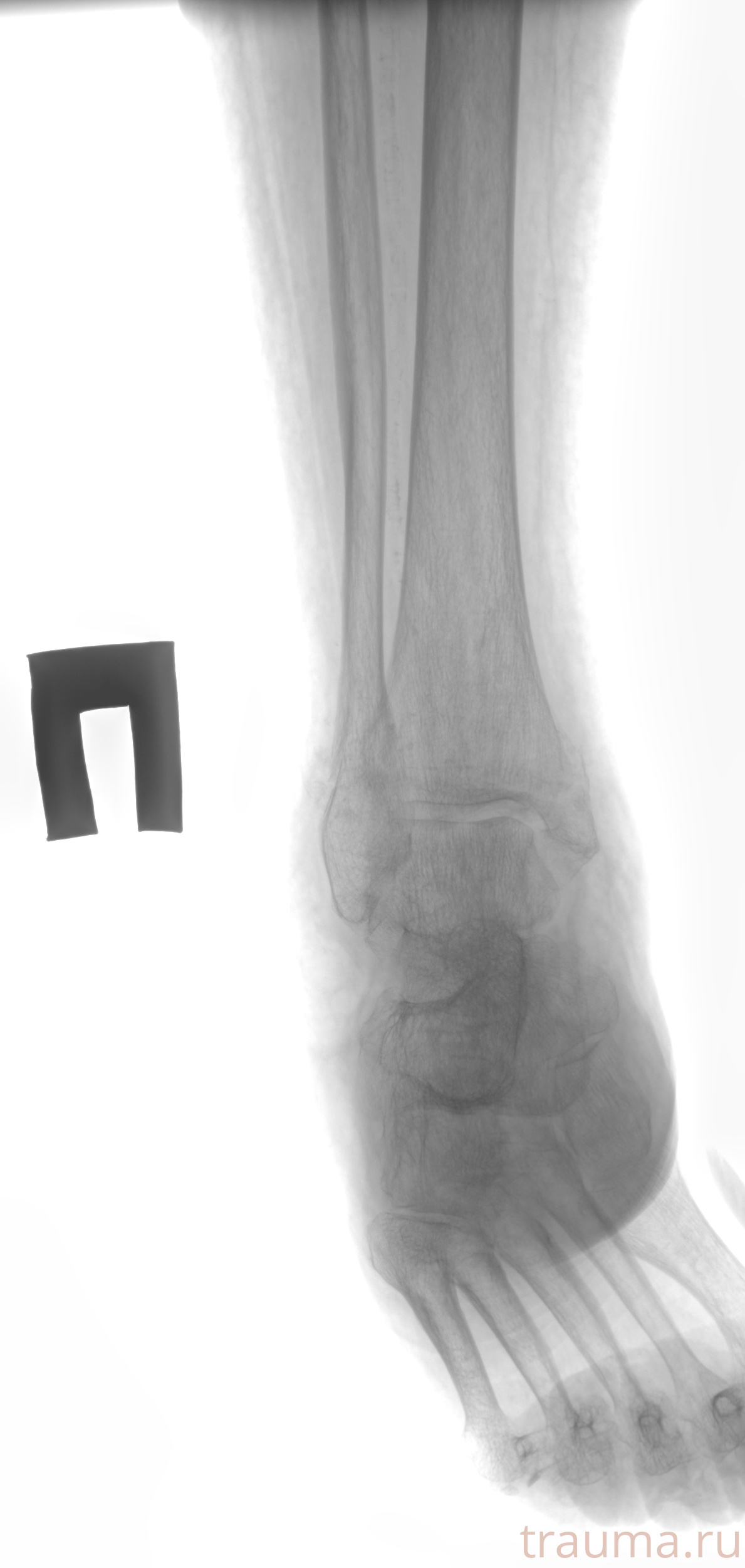 Рентген на дому: по вашему адресу приезжает врач-рентгенолог, травматолог-ортопед с мобильным рентгеновским аппаратом, проводит диагностику травмы или заболевания, делает необходимые рентгенограммы, дает рекомендации по дальнейшему лечению. Получить качественные снимки в домашних условиях возможно благодаря уникальной методике, разработанной МосРентген Центром для института  Склифосовского