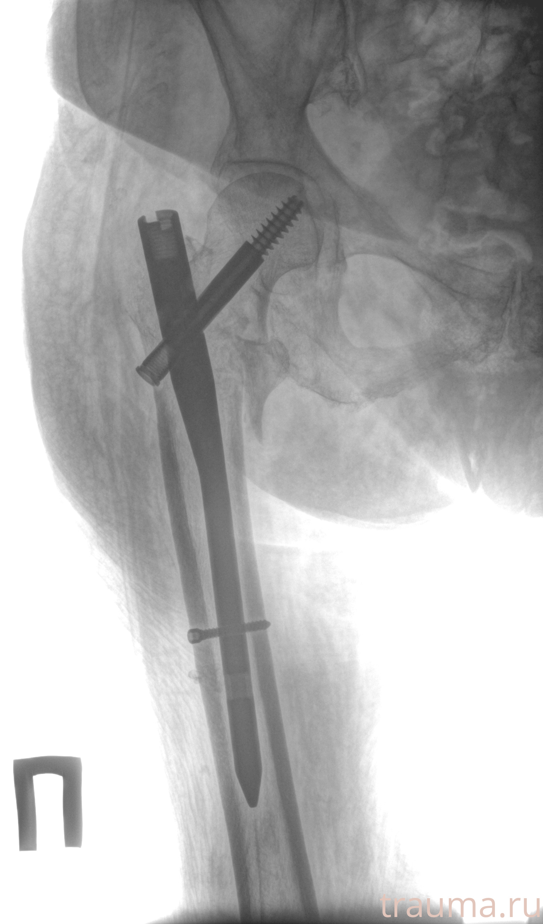 Рентген на дому: по вашему адресу приезжает врач-рентгенолог, травматолог-ортопед с мобильным рентгеновским аппаратом, проводит диагностику травмы или заболевания, делает необходимые рентгенограммы, дает рекомендации по дальнейшему лечению. Получить качественные снимки в домашних условиях возможно благодаря уникальной методике, разработанной МосРентген Центром для института  Склифосовского