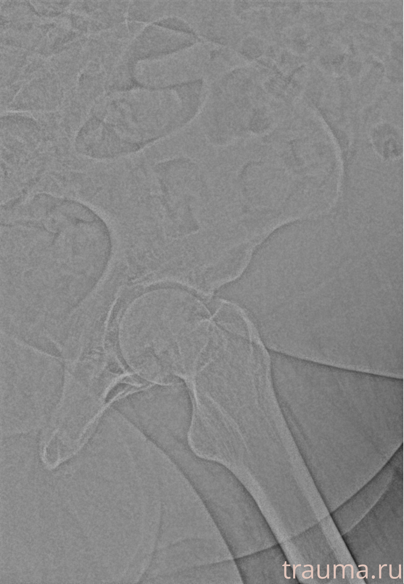 Рентген на дому: по вашему адресу приезжает врач-рентгенолог, травматолог-ортопед с мобильным рентгеновским аппаратом, проводит диагностику травмы или заболевания, делает необходимые рентгенограммы, дает рекомендации по дальнейшему лечению. Получить качественные снимки в домашних условиях возможно благодаря уникальной методике, разработанной МосРентген Центром для института  Склифосовского