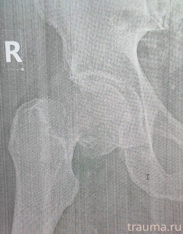 Рентген на дому: по вашему адресу приезжает врач-рентгенолог, травматолог-ортопед с мобильным рентгеновским аппаратом, проводит диагностику травмы или заболевания, делает необходимые рентгенограммы, дает рекомендации по дальнейшему лечению. Получить качественные снимки в домашних условиях возможно благодаря уникальной методике, разработанной МосРентген Центром для института  Склифосовского