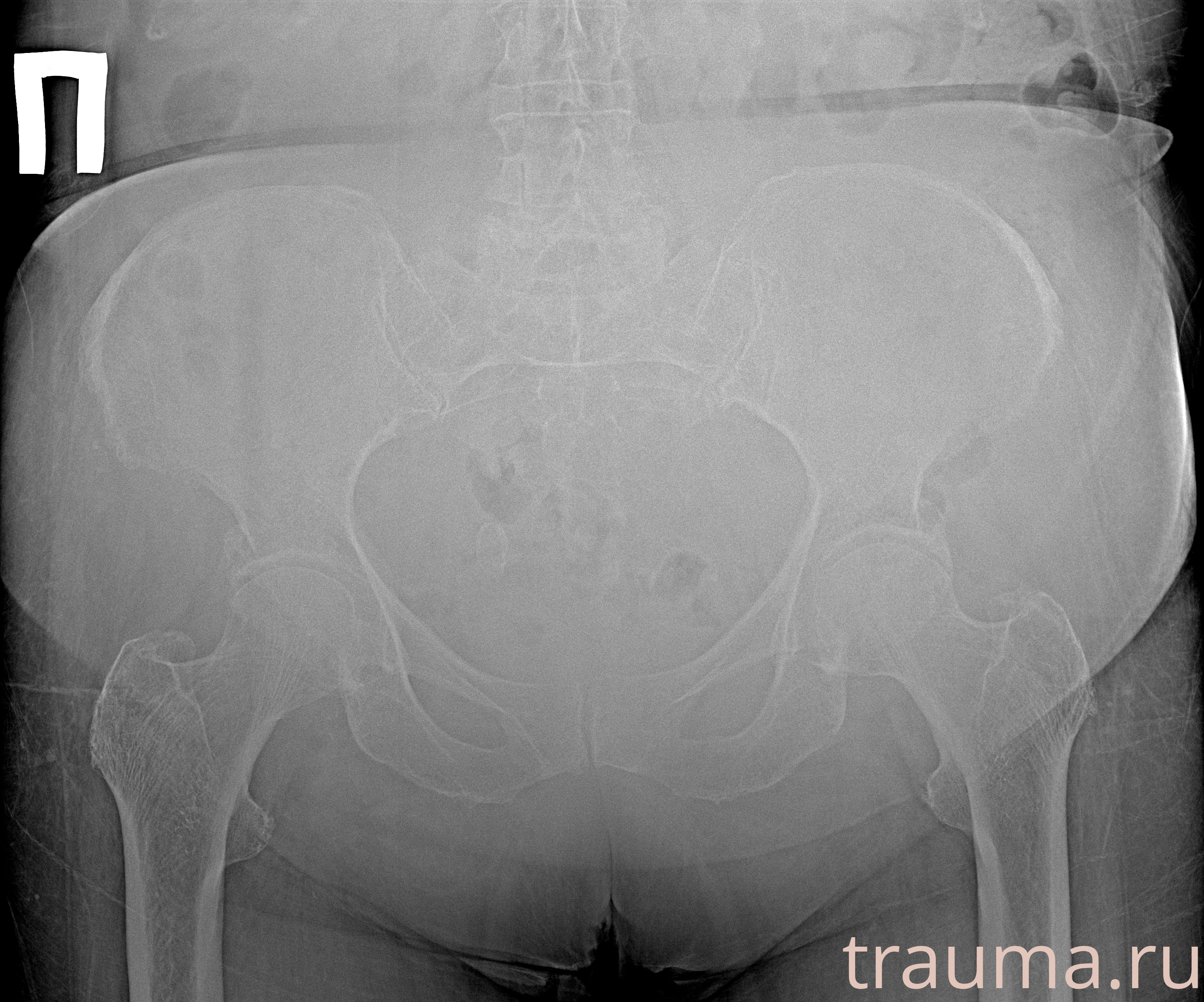 Рентген на дому: по вашему адресу приезжает врач-рентгенолог, травматолог-ортопед с мобильным рентгеновским аппаратом, проводит диагностику травмы или заболевания, делает необходимые рентгенограммы, дает рекомендации по дальнейшему лечению. Получить качественные снимки в домашних условиях возможно благодаря уникальной методике, разработанной МосРентген Центром для института  Склифосовского