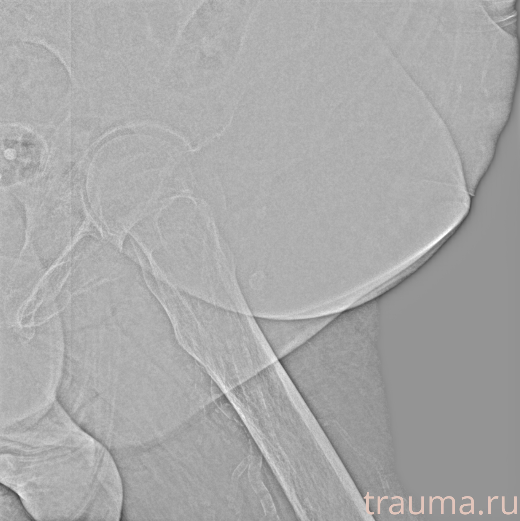 Рентген на дому: по вашему адресу приезжает врач-рентгенолог, травматолог-ортопед с мобильным рентгеновским аппаратом, проводит диагностику травмы или заболевания, делает необходимые рентгенограммы, дает рекомендации по дальнейшему лечению. Получить качественные снимки в домашних условиях возможно благодаря уникальной методике, разработанной МосРентген Центром для института  Склифосовского