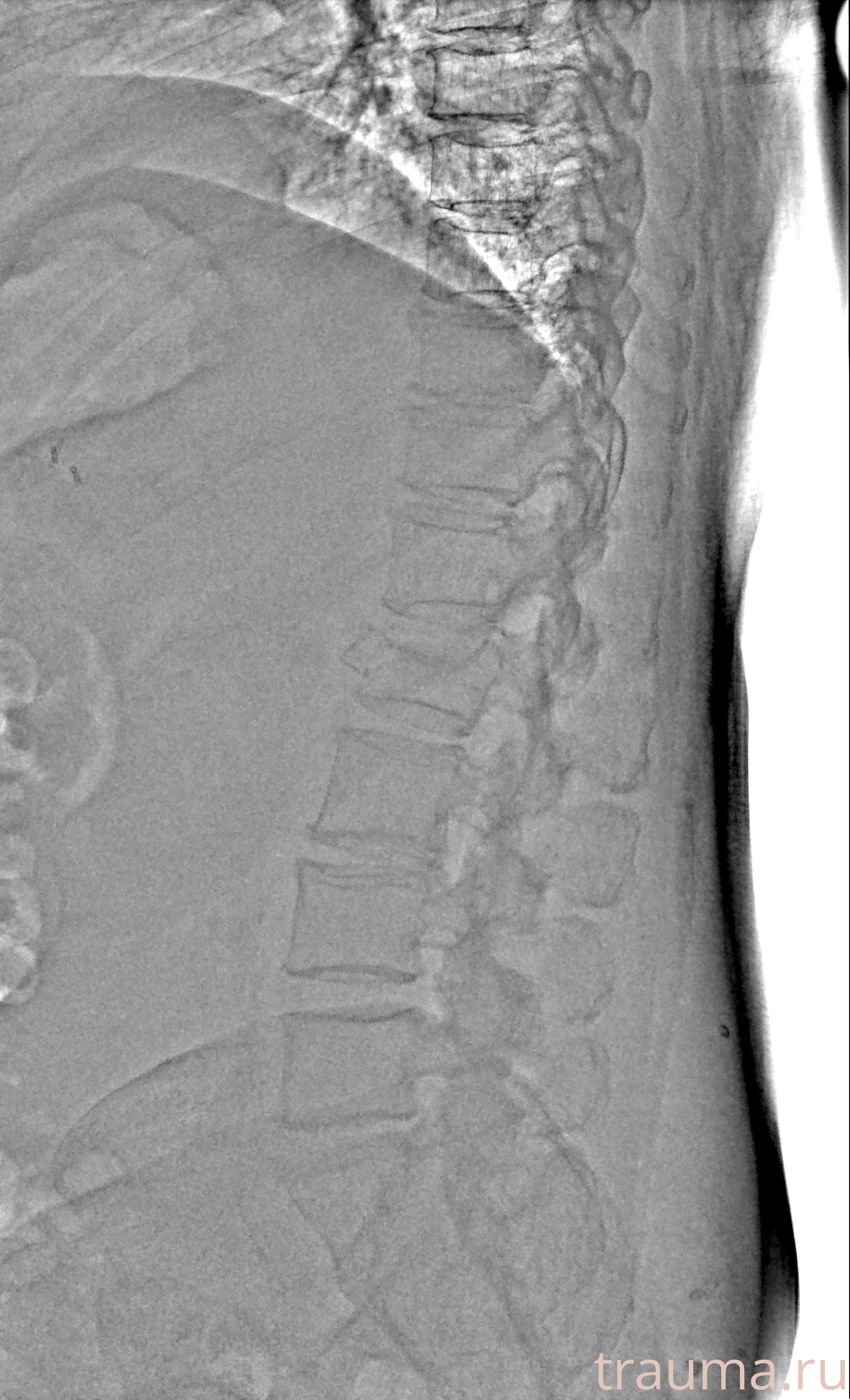 Рентген на дому: по вашему адресу приезжает врач-рентгенолог, травматолог-ортопед с мобильным рентгеновским аппаратом, проводит диагностику травмы или заболевания, делает необходимые рентгенограммы, дает рекомендации по дальнейшему лечению. Получить качественные снимки в домашних условиях возможно благодаря уникальной методике, разработанной МосРентген Центром для института  Склифосовского