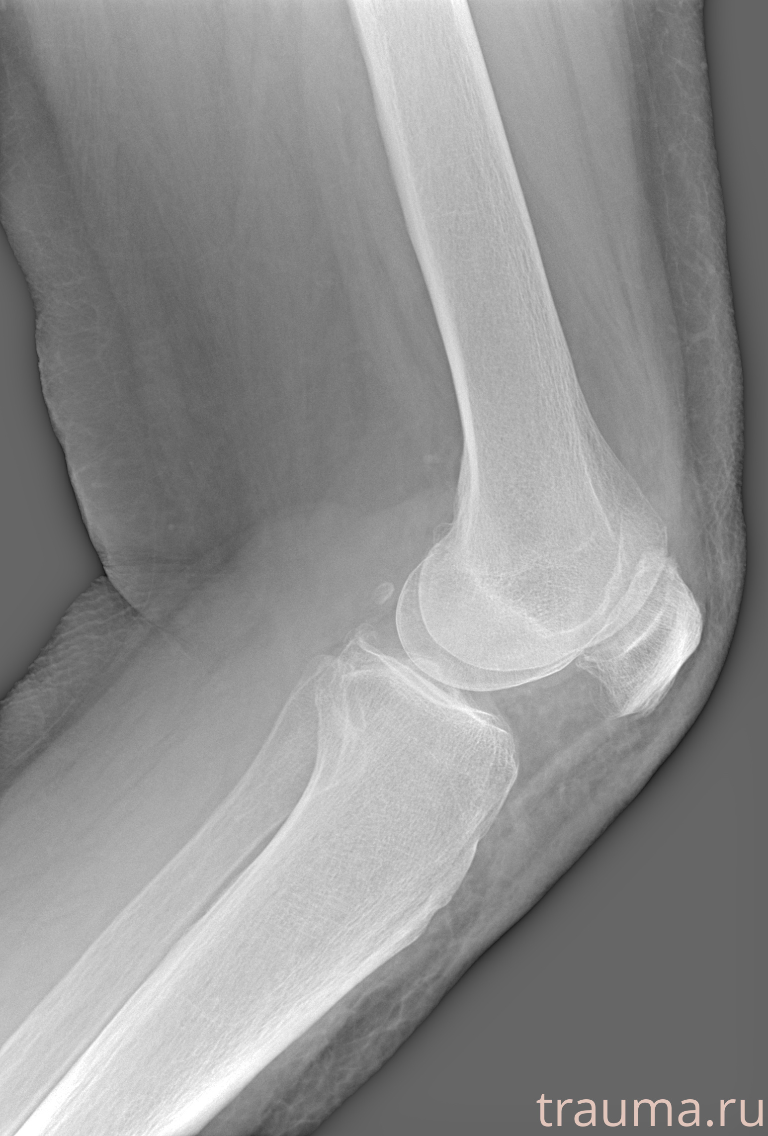 Рентген на дому: по вашему адресу приезжает врач-рентгенолог, травматолог-ортопед с мобильным рентгеновским аппаратом, проводит диагностику травмы или заболевания, делает необходимые рентгенограммы, дает рекомендации по дальнейшему лечению. Получить качественные снимки в домашних условиях возможно благодаря уникальной методике, разработанной МосРентген Центром для института  Склифосовского