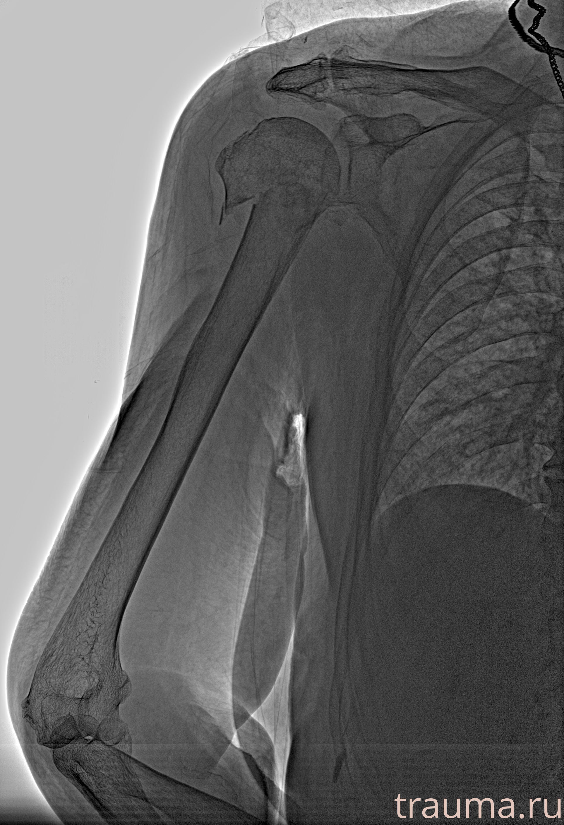 Рентген на дому: по вашему адресу приезжает врач-рентгенолог, травматолог-ортопед с мобильным рентгеновским аппаратом, проводит диагностику травмы или заболевания, делает необходимые рентгенограммы, дает рекомендации по дальнейшему лечению. Получить качественные снимки в домашних условиях возможно благодаря уникальной методике, разработанной МосРентген Центром для института  Склифосовского