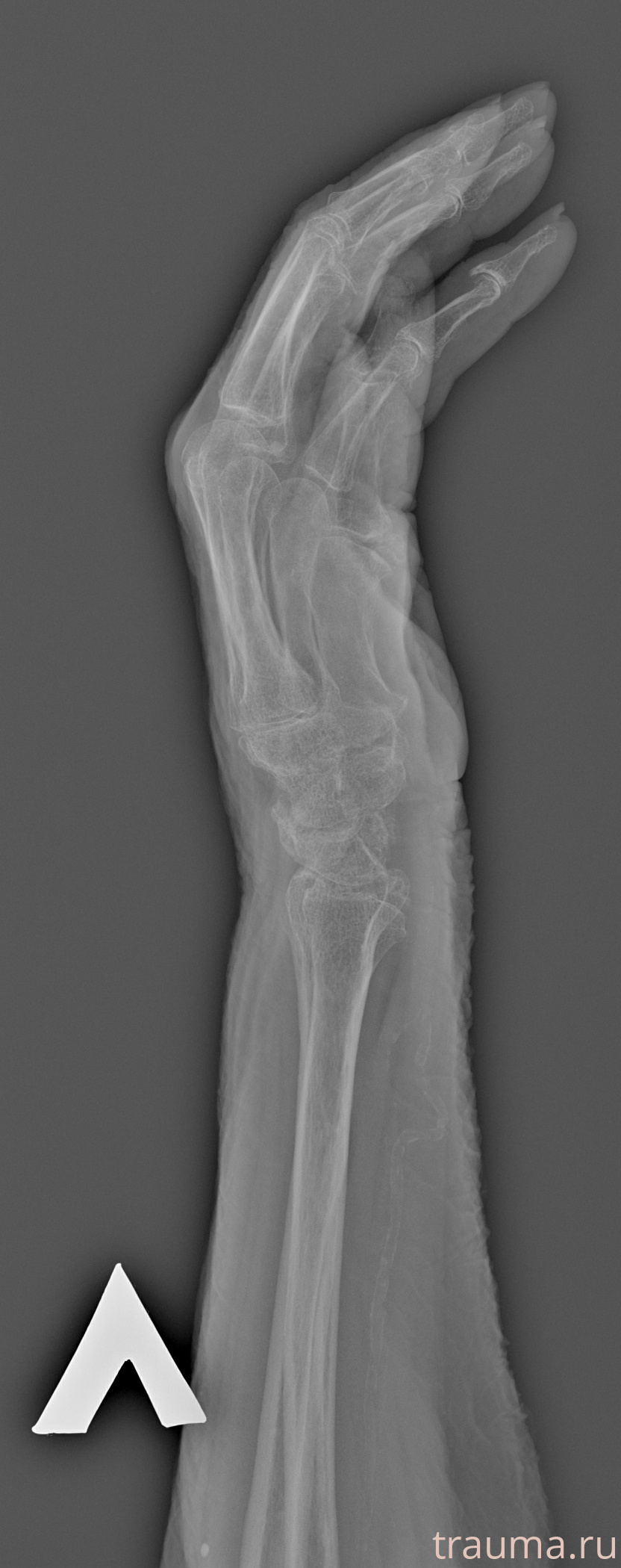 Рентген на дому: по вашему адресу приезжает врач-рентгенолог, травматолог-ортопед с мобильным рентгеновским аппаратом, проводит диагностику травмы или заболевания, делает необходимые рентгенограммы, дает рекомендации по дальнейшему лечению. Получить качественные снимки в домашних условиях возможно благодаря уникальной методике, разработанной МосРентген Центром для института  Склифосовского