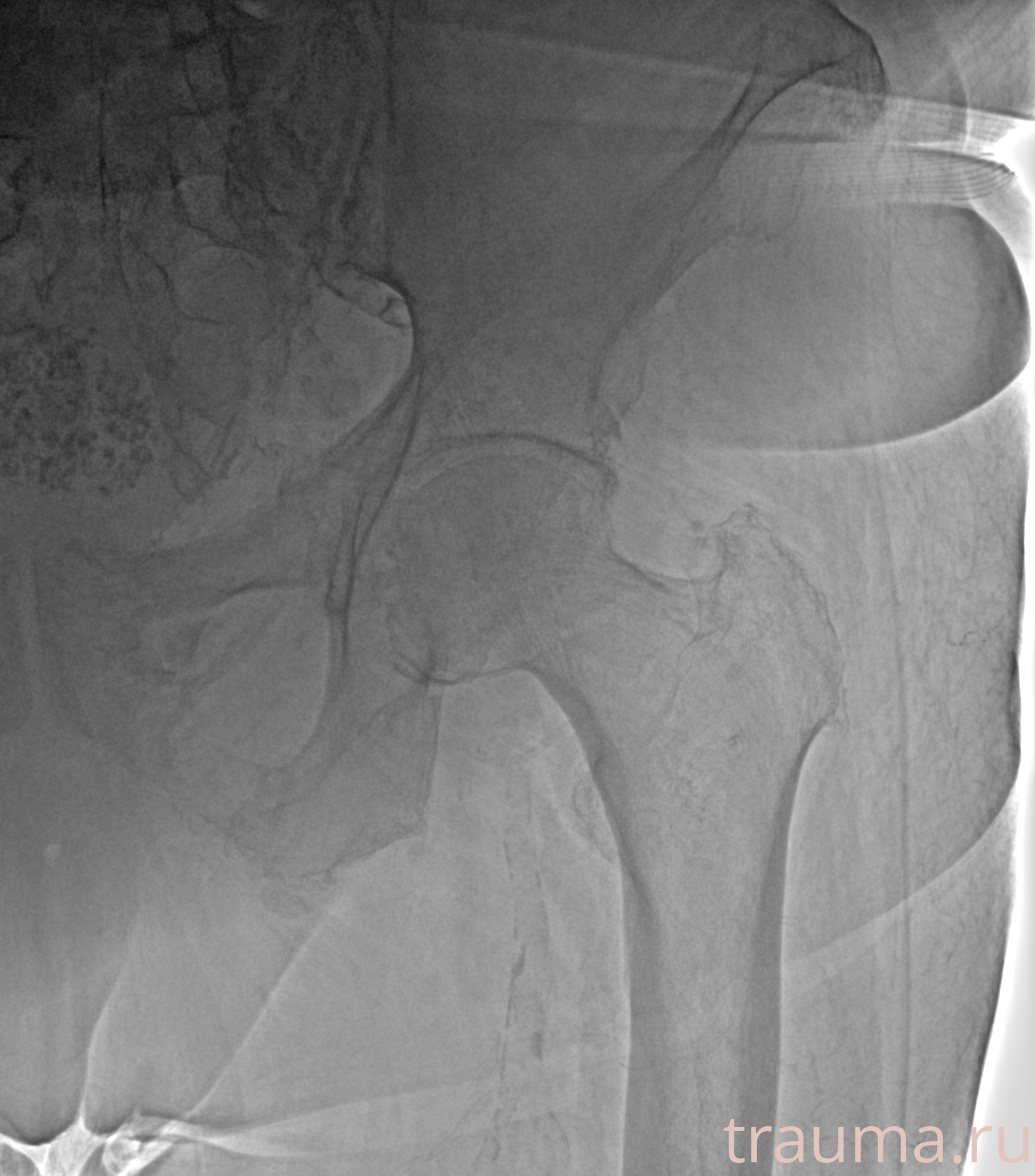 Рентген на дому: по вашему адресу приезжает врач-рентгенолог, травматолог-ортопед с мобильным рентгеновским аппаратом, проводит диагностику травмы или заболевания, делает необходимые рентгенограммы, дает рекомендации по дальнейшему лечению. Получить качественные снимки в домашних условиях возможно благодаря уникальной методике, разработанной МосРентген Центром для института  Склифосовского