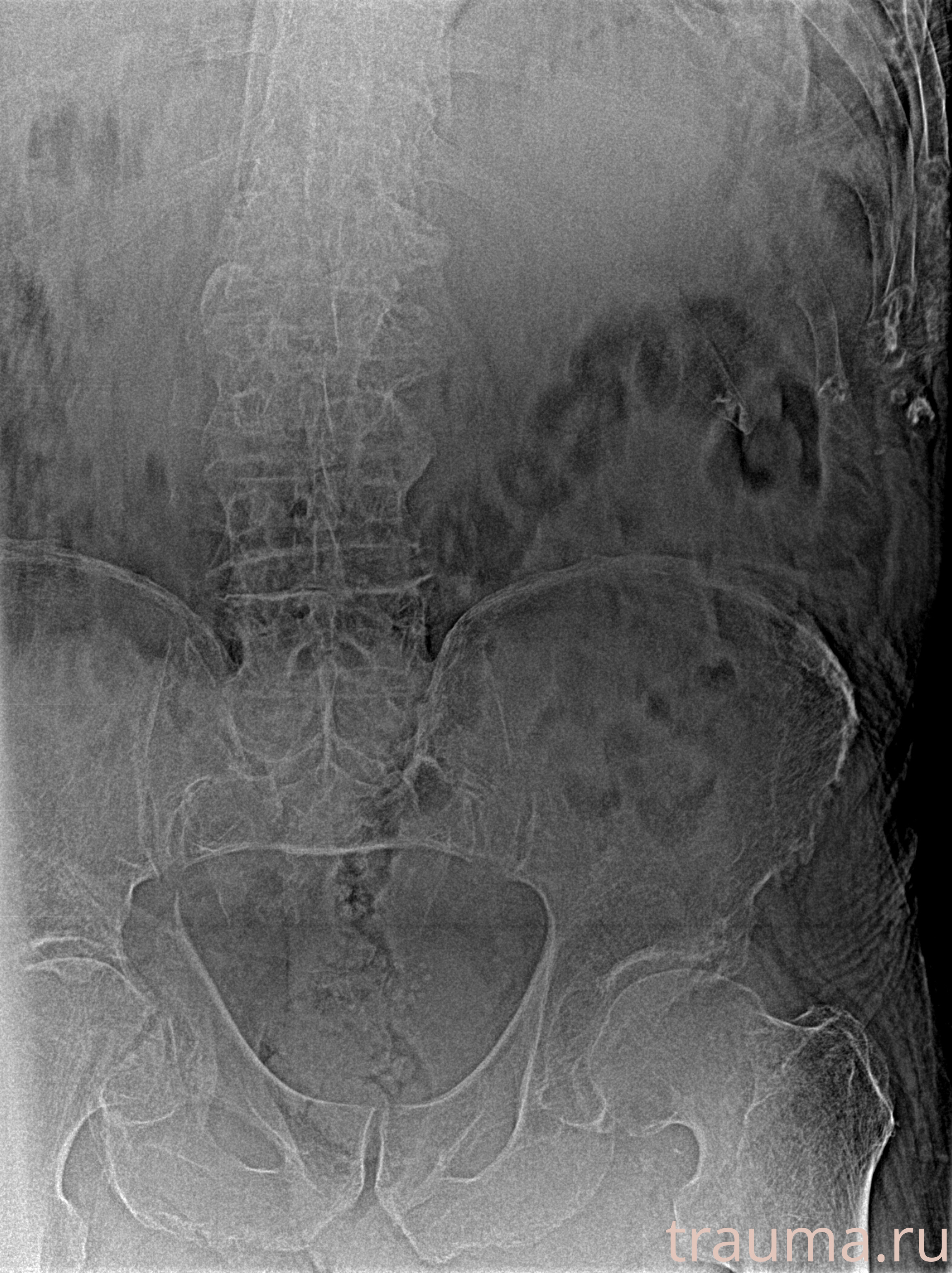 Рентген на дому: по вашему адресу приезжает врач-рентгенолог, травматолог-ортопед с мобильным рентгеновским аппаратом, проводит диагностику травмы или заболевания, делает необходимые рентгенограммы, дает рекомендации по дальнейшему лечению. Получить качественные снимки в домашних условиях возможно благодаря уникальной методике, разработанной МосРентген Центром для института  Склифосовского
