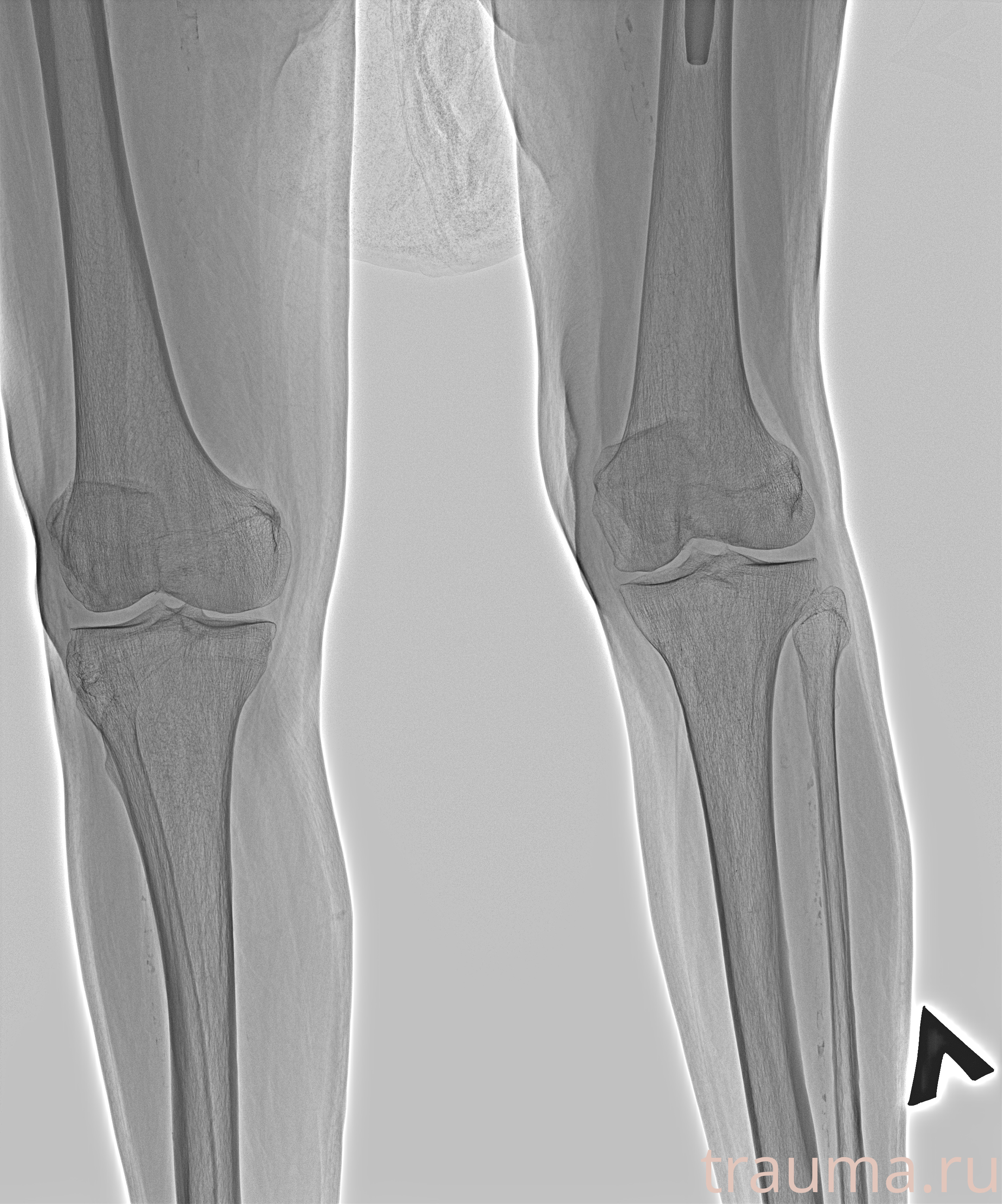 Рентген на дому: по вашему адресу приезжает врач-рентгенолог, травматолог-ортопед с мобильным рентгеновским аппаратом, проводит диагностику травмы или заболевания, делает необходимые рентгенограммы, дает рекомендации по дальнейшему лечению. Получить качественные снимки в домашних условиях возможно благодаря уникальной методике, разработанной МосРентген Центром для института  Склифосовского
