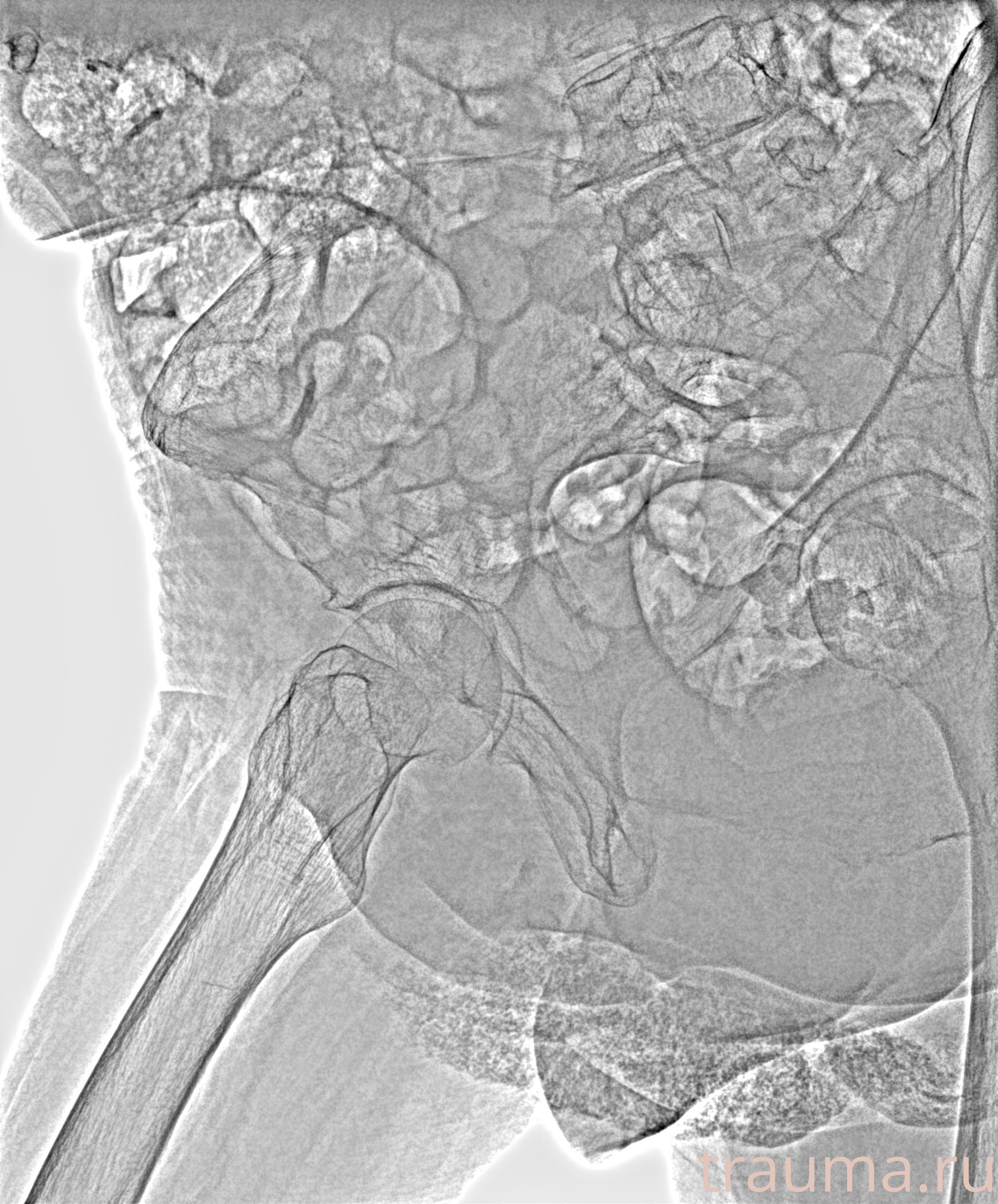 Рентген на дому: по вашему адресу приезжает врач-рентгенолог, травматолог-ортопед с мобильным рентгеновским аппаратом, проводит диагностику травмы или заболевания, делает необходимые рентгенограммы, дает рекомендации по дальнейшему лечению. Получить качественные снимки в домашних условиях возможно благодаря уникальной методике, разработанной МосРентген Центром для института  Склифосовского
