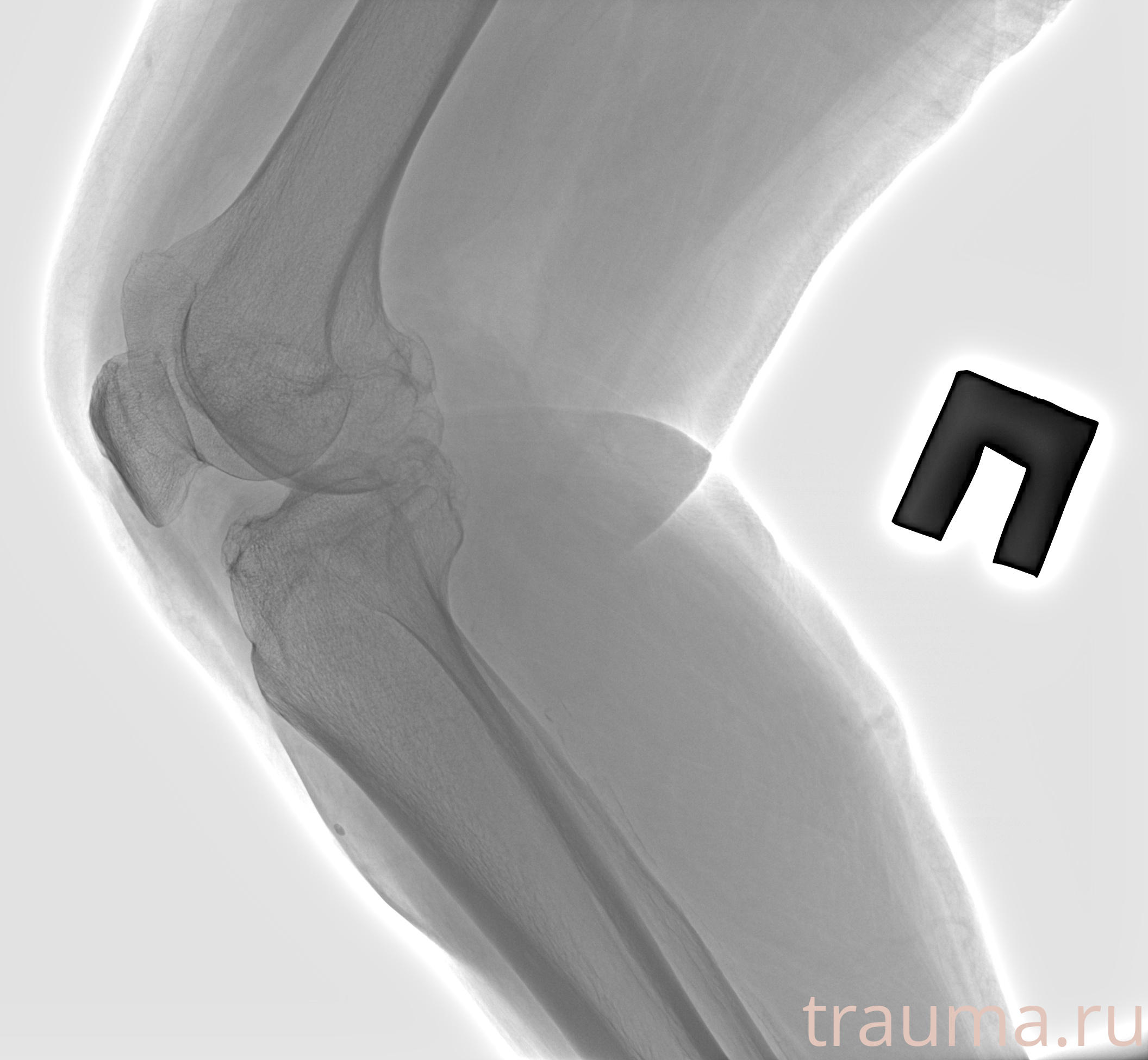 Рентген на дому: по вашему адресу приезжает врач-рентгенолог, травматолог-ортопед с мобильным рентгеновским аппаратом, проводит диагностику травмы или заболевания, делает необходимые рентгенограммы, дает рекомендации по дальнейшему лечению. Получить качественные снимки в домашних условиях возможно благодаря уникальной методике, разработанной МосРентген Центром для института  Склифосовского