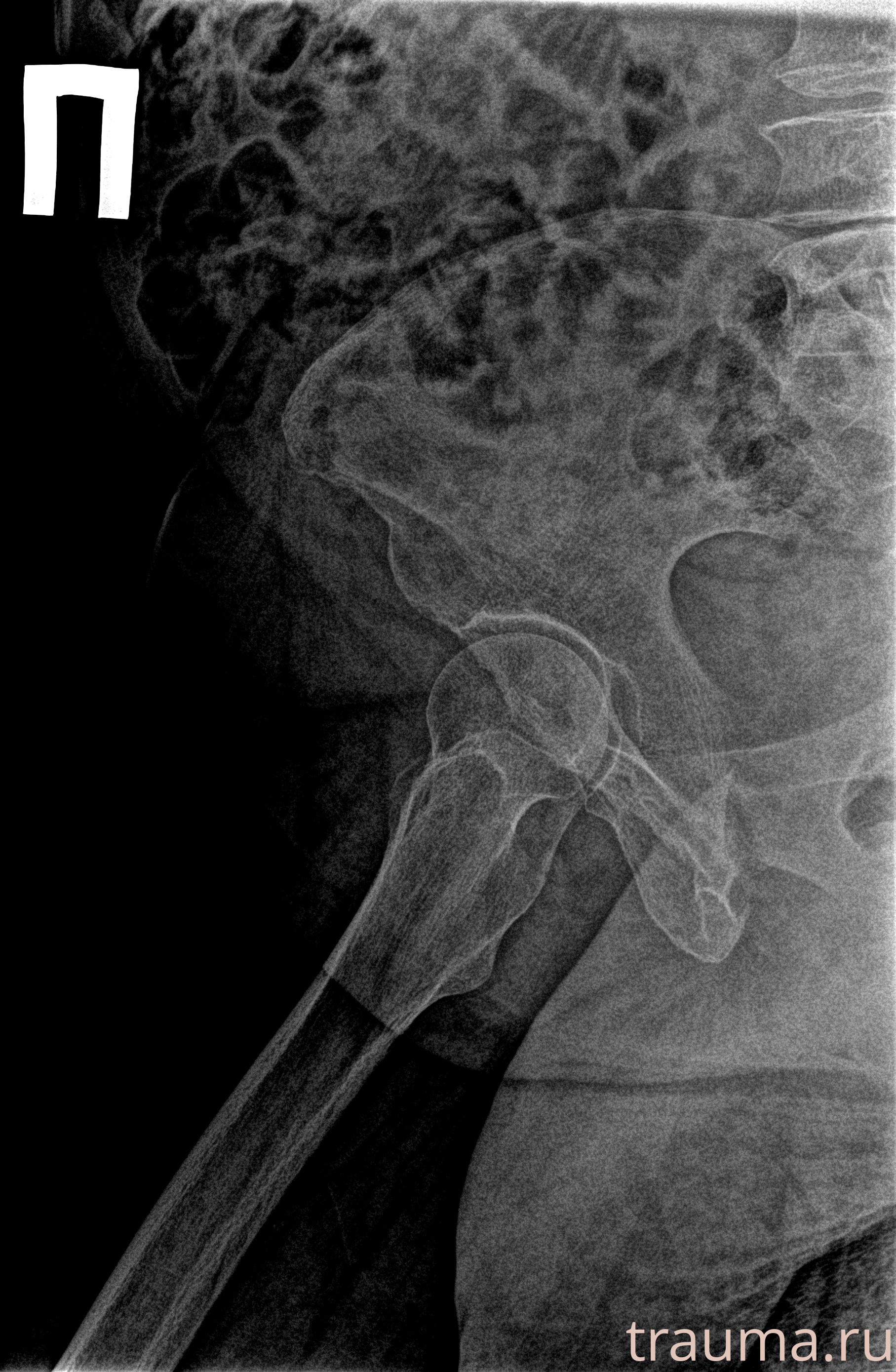 Рентген на дому: по вашему адресу приезжает врач-рентгенолог, травматолог-ортопед с мобильным рентгеновским аппаратом, проводит диагностику травмы или заболевания, делает необходимые рентгенограммы, дает рекомендации по дальнейшему лечению. Получить качественные снимки в домашних условиях возможно благодаря уникальной методике, разработанной МосРентген Центром для института  Склифосовского