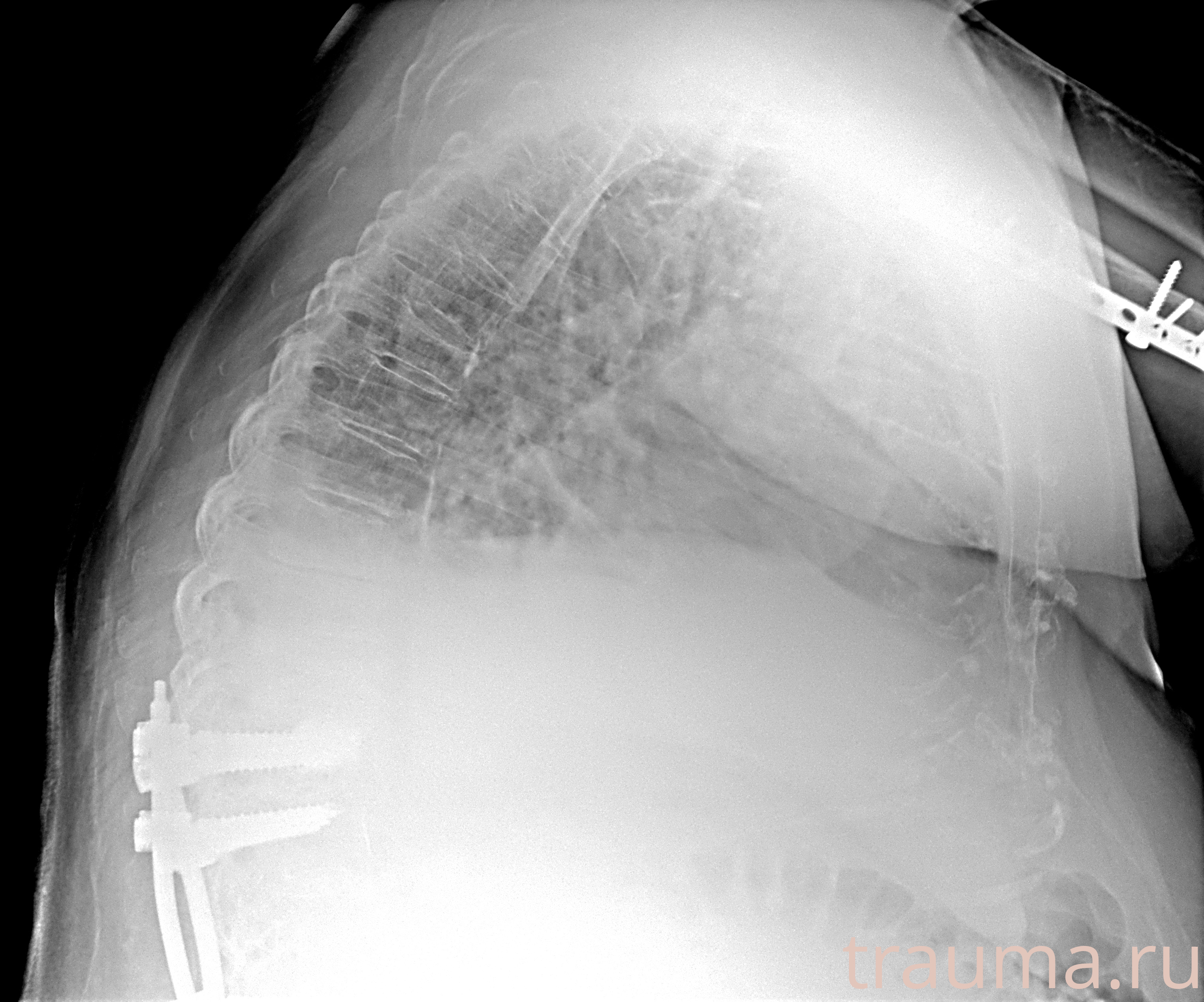 Рентген на дому: по вашему адресу приезжает врач-рентгенолог, травматолог-ортопед с мобильным рентгеновским аппаратом, проводит диагностику травмы или заболевания, делает необходимые рентгенограммы, дает рекомендации по дальнейшему лечению. Получить качественные снимки в домашних условиях возможно благодаря уникальной методике, разработанной МосРентген Центром для института  Склифосовского