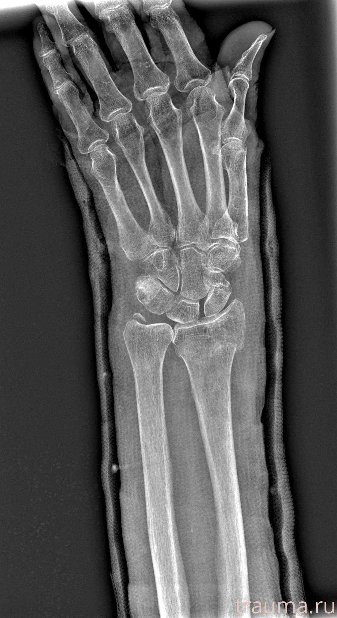 Рентген на дому: по вашему адресу приезжает врач-рентгенолог, травматолог-ортопед с мобильным рентгеновским аппаратом, проводит диагностику травмы или заболевания, делает необходимые рентгенограммы, дает рекомендации по дальнейшему лечению. Получить качественные снимки в домашних условиях возможно благодаря уникальной методике, разработанной МосРентген Центром для института  Склифосовского