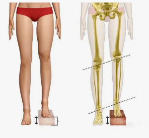 Несоответствие в длине нижних конечностей  у пациентов с коксовертабельным синдромом  Несоответствие в длине нижних конечностей  у пациентов с коксовертабельным синдромом