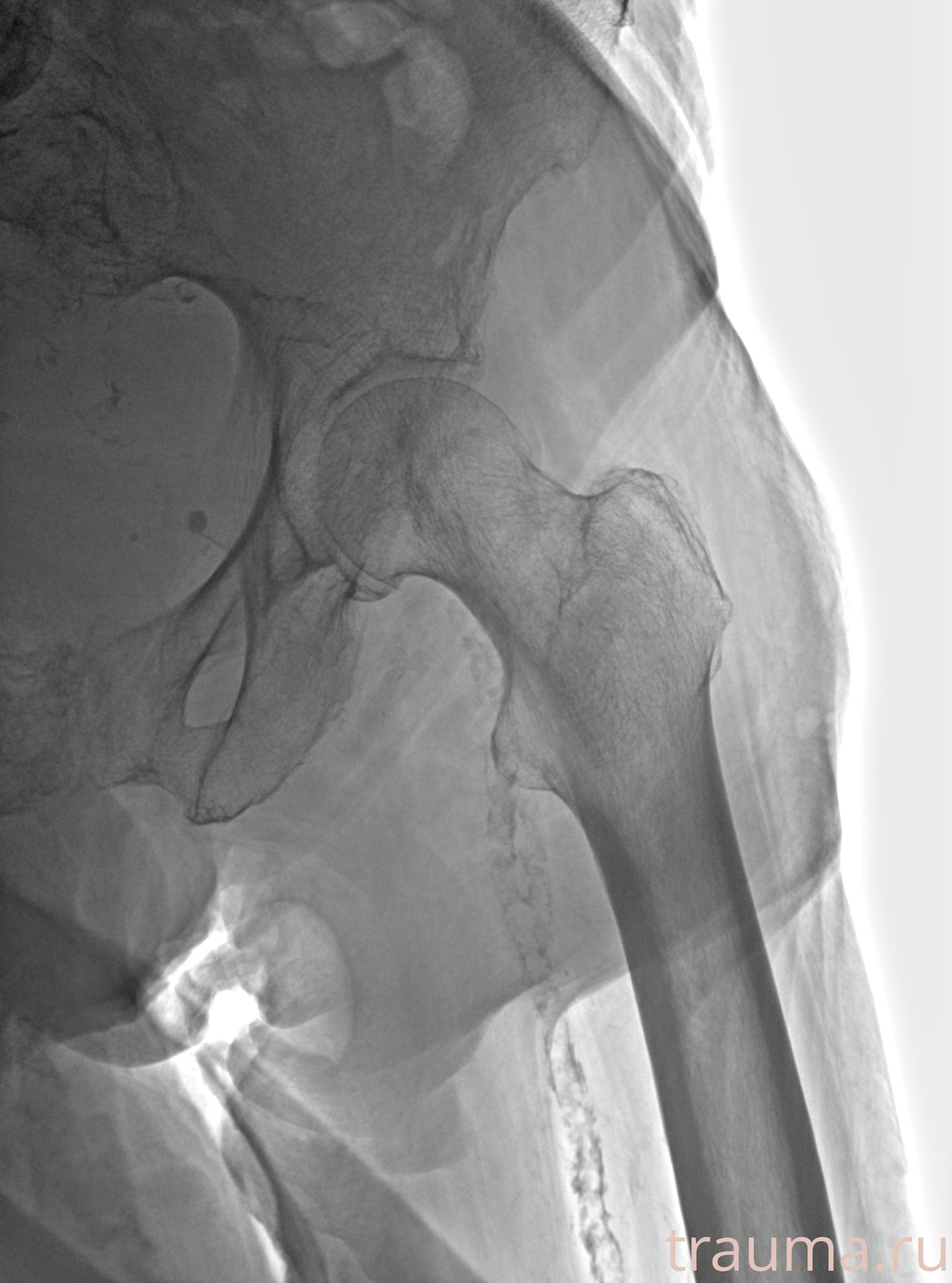 Рентген на дому: по вашему адресу приезжает врач-рентгенолог, травматолог-ортопед с мобильным рентгеновским аппаратом, проводит диагностику травмы или заболевания, делает необходимые рентгенограммы, дает рекомендации по дальнейшему лечению. Получить качественные снимки в домашних условиях возможно благодаря уникальной методике, разработанной МосРентген Центром для института  Склифосовского