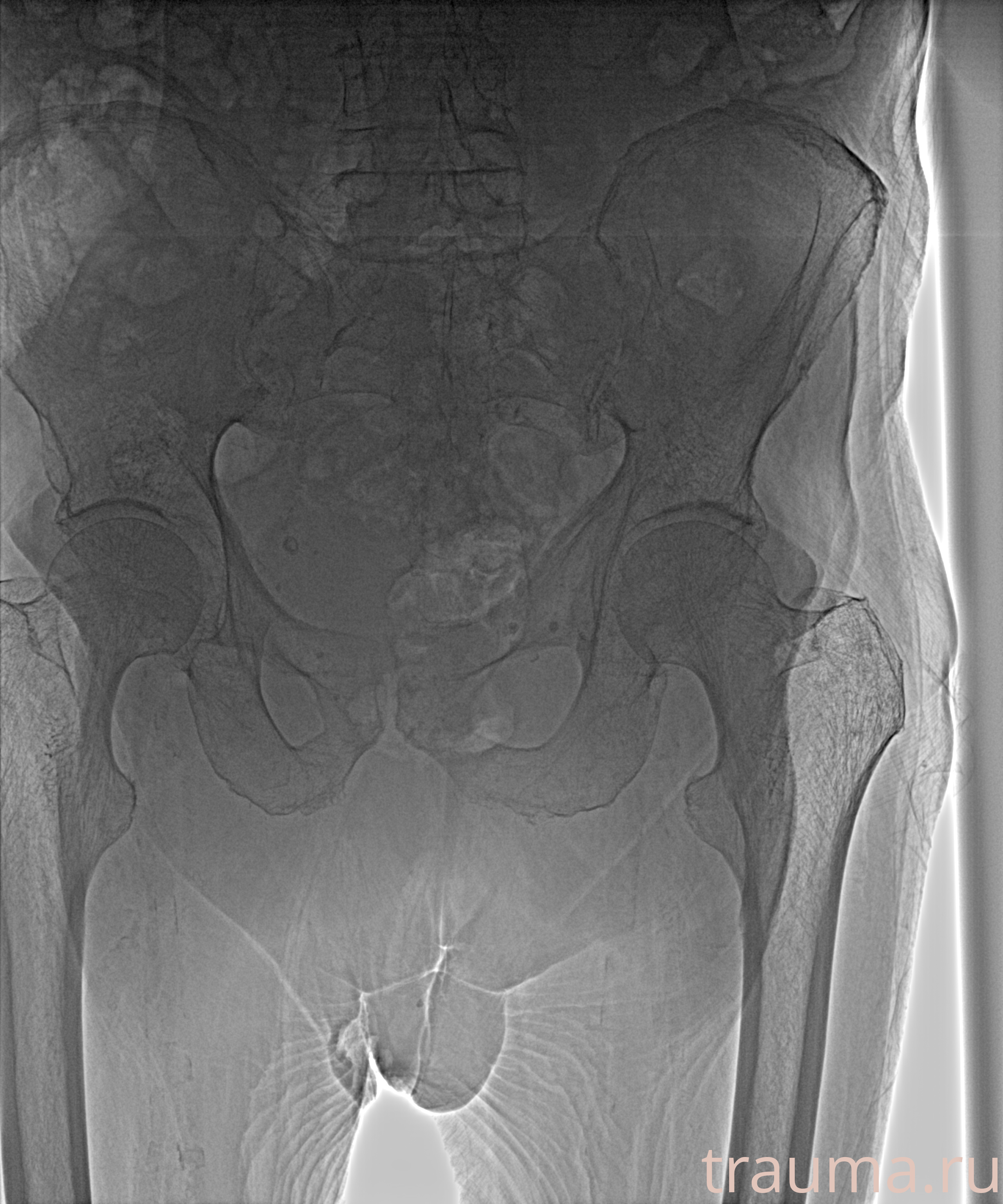 Рентген на дому: по вашему адресу приезжает врач-рентгенолог, травматолог-ортопед с мобильным рентгеновским аппаратом, проводит диагностику травмы или заболевания, делает необходимые рентгенограммы, дает рекомендации по дальнейшему лечению. Получить качественные снимки в домашних условиях возможно благодаря уникальной методике, разработанной МосРентген Центром для института  Склифосовского