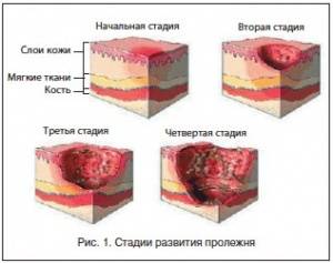 Лечение пролежней у малоподвижных пациентов Лечение пролежней у малоподвижных пациентов