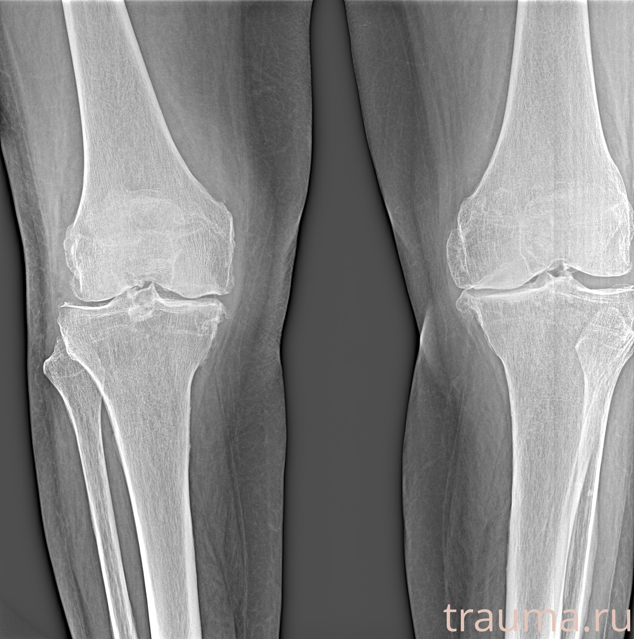 Рентген на дому: по вашему адресу приезжает врач-рентгенолог, травматолог-ортопед с мобильным рентгеновским аппаратом, проводит диагностику травмы или заболевания, делает необходимые рентгенограммы, дает рекомендации по дальнейшему лечению. Получить качественные снимки в домашних условиях возможно благодаря уникальной методике, разработанной МосРентген Центром для института  Склифосовского