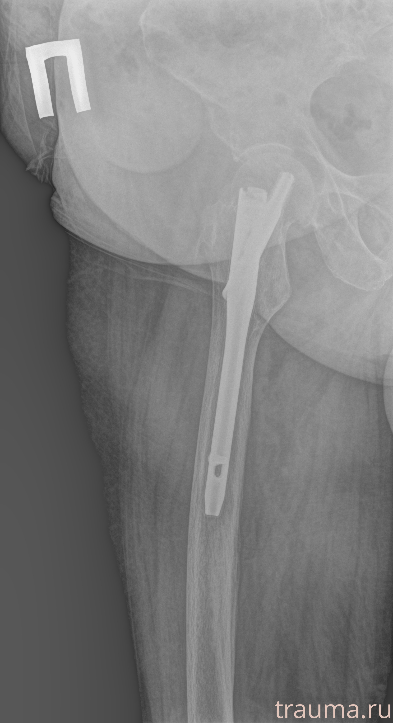 Рентген на дому: по вашему адресу приезжает врач-рентгенолог, травматолог-ортопед с мобильным рентгеновским аппаратом, проводит диагностику травмы или заболевания, делает необходимые рентгенограммы, дает рекомендации по дальнейшему лечению. Получить качественные снимки в домашних условиях возможно благодаря уникальной методике, разработанной МосРентген Центром для института  Склифосовского