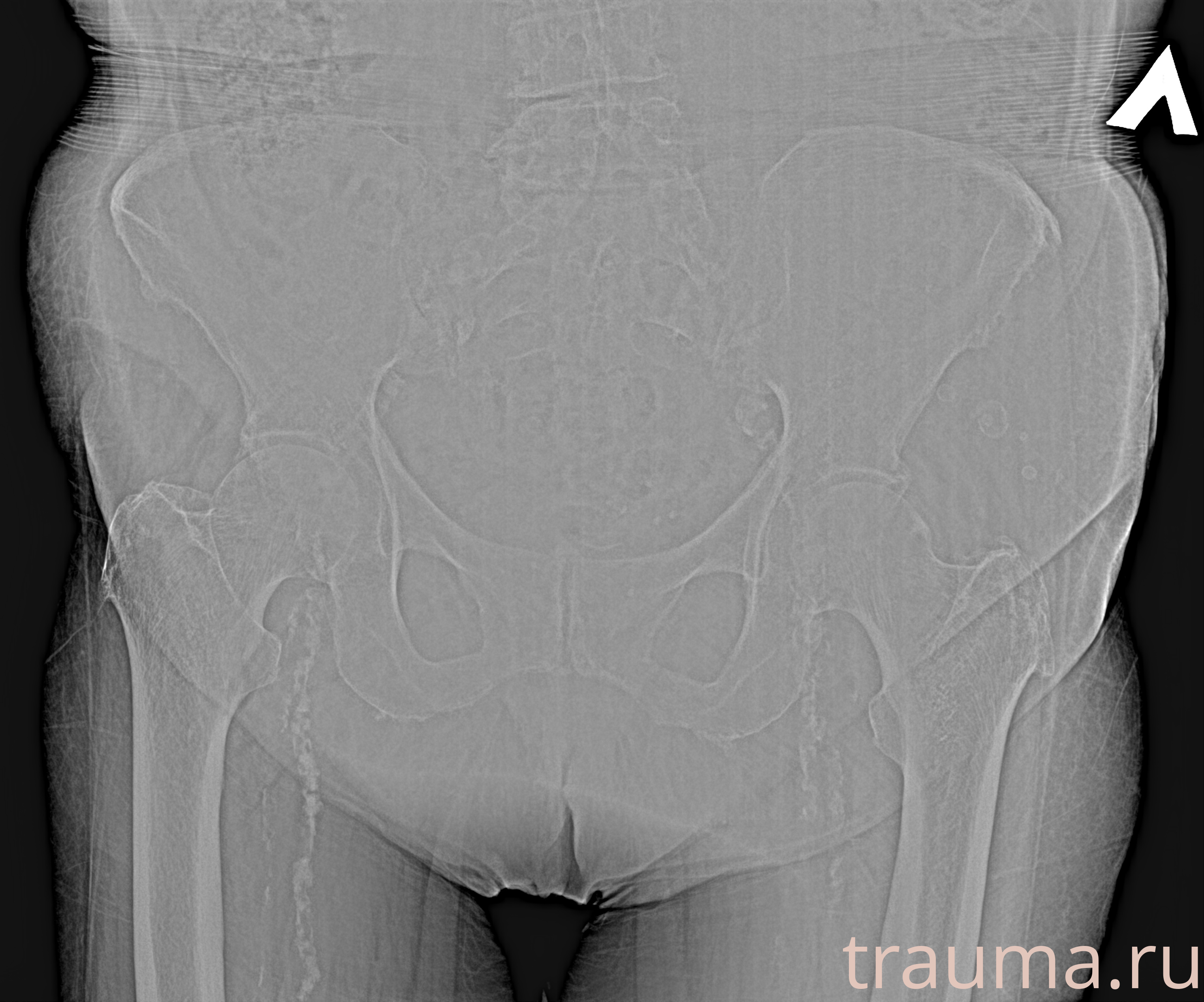 Рентген на дому: по вашему адресу приезжает врач-рентгенолог, травматолог-ортопед с мобильным рентгеновским аппаратом, проводит диагностику травмы или заболевания, делает необходимые рентгенограммы, дает рекомендации по дальнейшему лечению. Получить качественные снимки в домашних условиях возможно благодаря уникальной методике, разработанной МосРентген Центром для института  Склифосовского