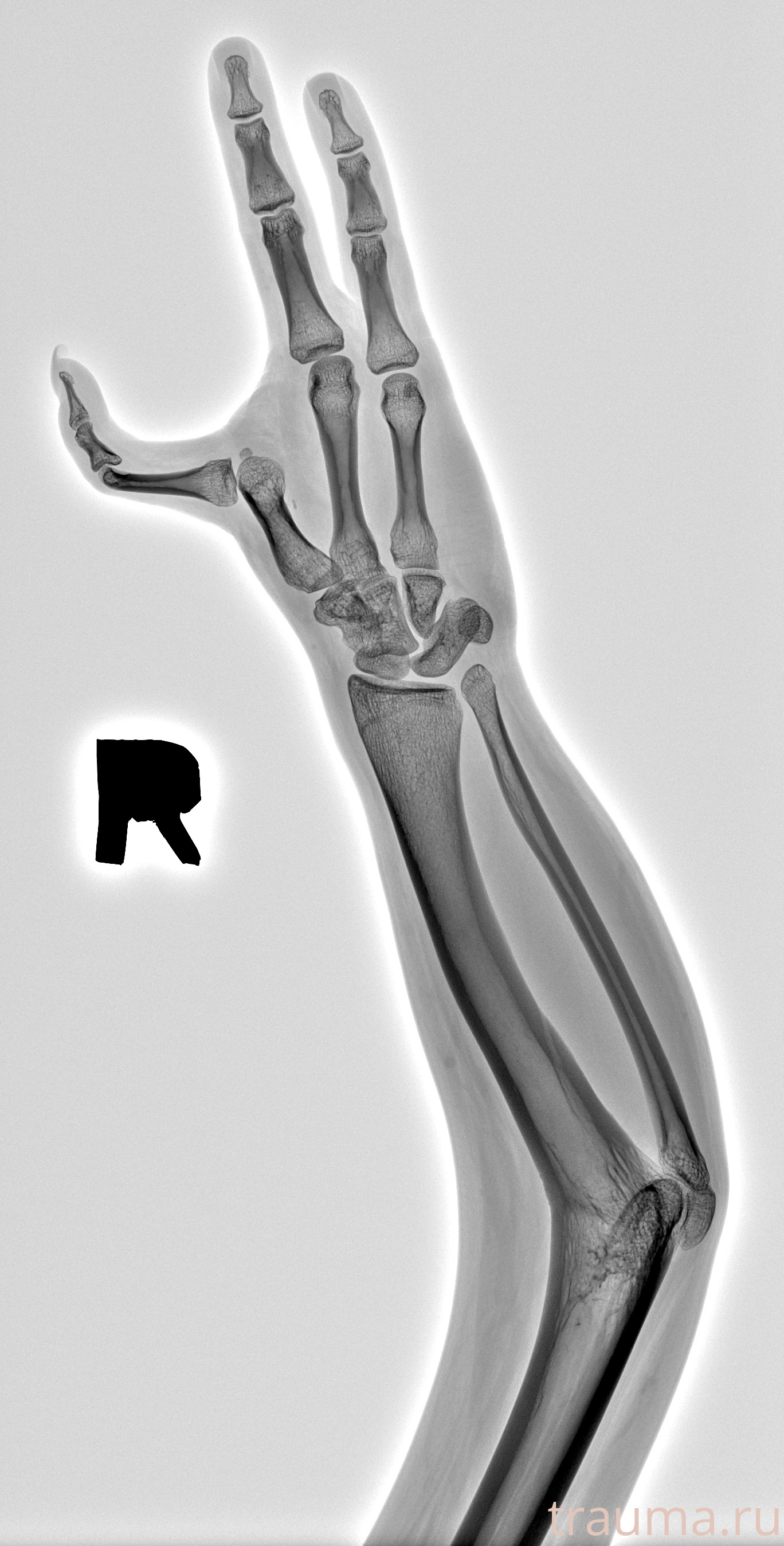 Рентген на дому: по вашему адресу приезжает врач-рентгенолог, травматолог-ортопед с мобильным рентгеновским аппаратом, проводит диагностику травмы или заболевания, делает необходимые рентгенограммы, дает рекомендации по дальнейшему лечению. Получить качественные снимки в домашних условиях возможно благодаря уникальной методике, разработанной МосРентген Центром для института  Склифосовского