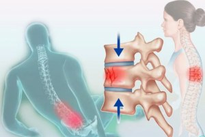 Клинический случай полного неврологического восстановления пациентки с тетраплегией вследствии позвоночно-спинальной травмы  Клинический случай полного неврологического восстановления пациентки с тетраплегией вследствии позвоночно-спинальной травмы