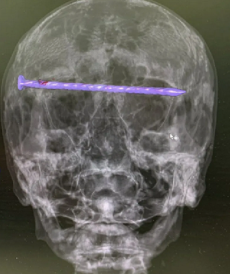 12-сантиметровый гвоздь насквозь пробил череп нижегородца и остался внутри 12-сантиметровый гвоздь насквозь пробил череп нижегородца и остался внутри