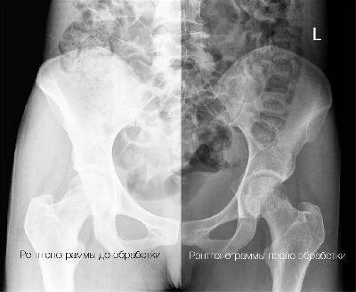 Перелом шейки бедра в условиях лишения свободы Перелом шейки бедра в условиях лишения свободы