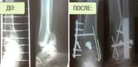Чрескостный остеосинтез по Илизарову при переломах заднего края дистального эпиметафиза большеберцовой кости Чрескостный остеосинтез по Илизарову при переломах заднего края дистального эпиметафиза большеберцовой кости