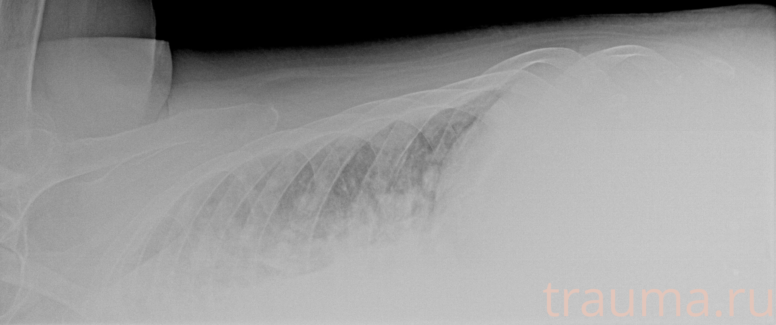 Рентген на дому: по вашему адресу приезжает врач-рентгенолог, травматолог-ортопед с мобильным рентгеновским аппаратом, проводит диагностику травмы или заболевания, делает необходимые рентгенограммы, дает рекомендации по дальнейшему лечению. Получить качественные снимки в домашних условиях возможно благодаря уникальной методике, разработанной МосРентген Центром для института  Склифосовского