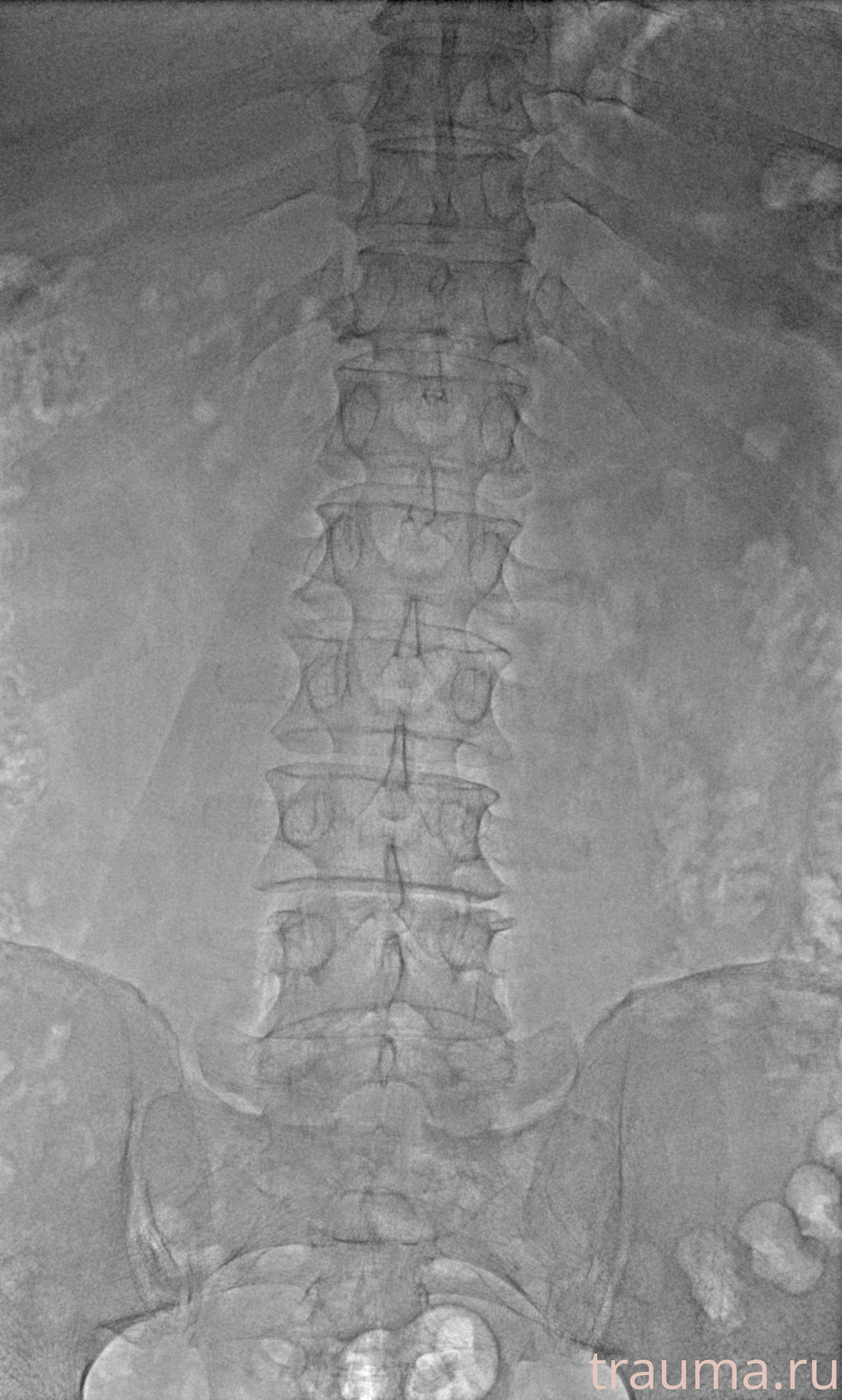 Рентген на дому: по вашему адресу приезжает врач-рентгенолог, травматолог-ортопед с мобильным рентгеновским аппаратом, проводит диагностику травмы или заболевания, делает необходимые рентгенограммы, дает рекомендации по дальнейшему лечению. Получить качественные снимки в домашних условиях возможно благодаря уникальной методике, разработанной МосРентген Центром для института  Склифосовского