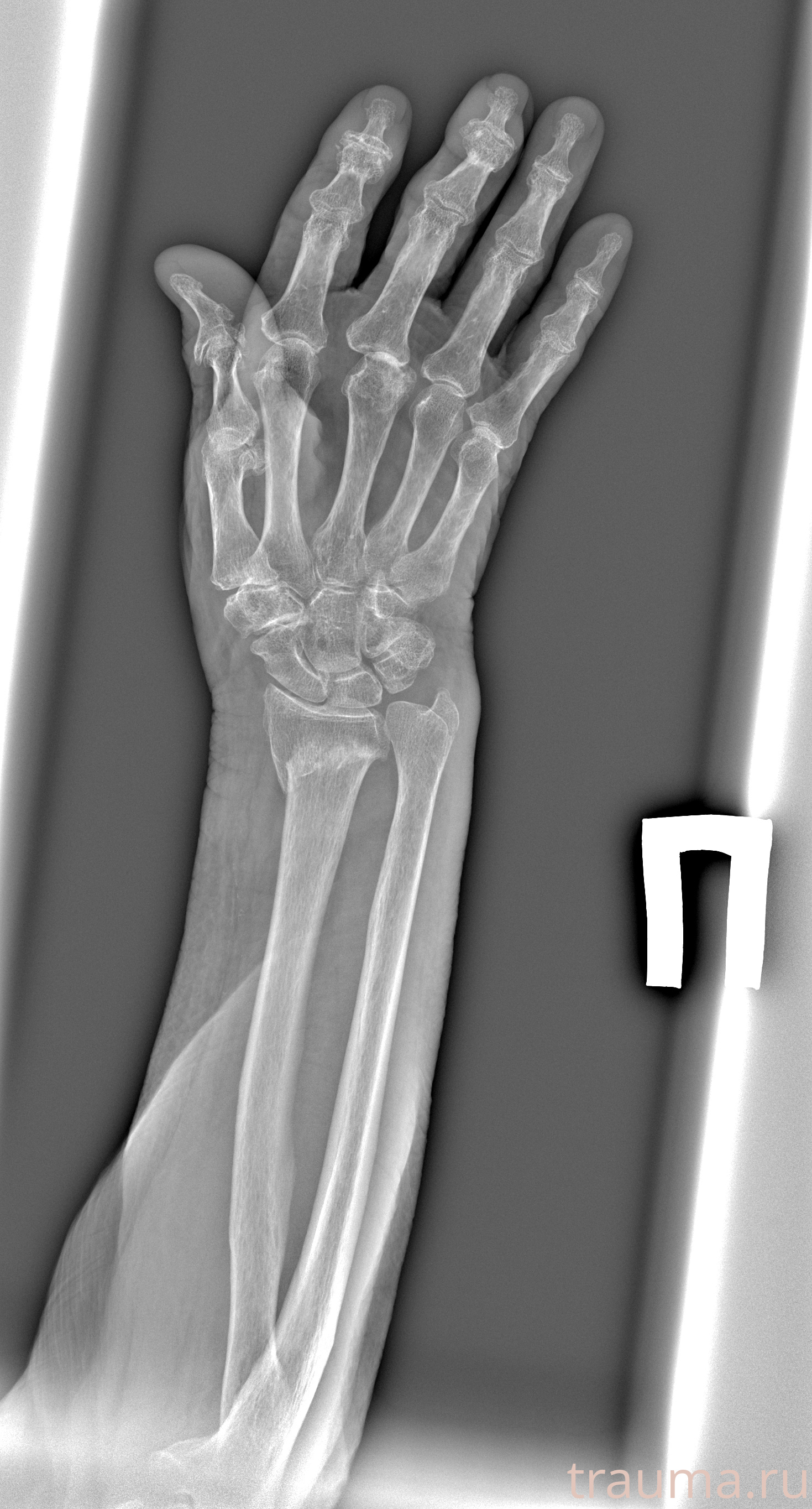 Рентген на дому: по вашему адресу приезжает врач-рентгенолог, травматолог-ортопед с мобильным рентгеновским аппаратом, проводит диагностику травмы или заболевания, делает необходимые рентгенограммы, дает рекомендации по дальнейшему лечению. Получить качественные снимки в домашних условиях возможно благодаря уникальной методике, разработанной МосРентген Центром для института  Склифосовского