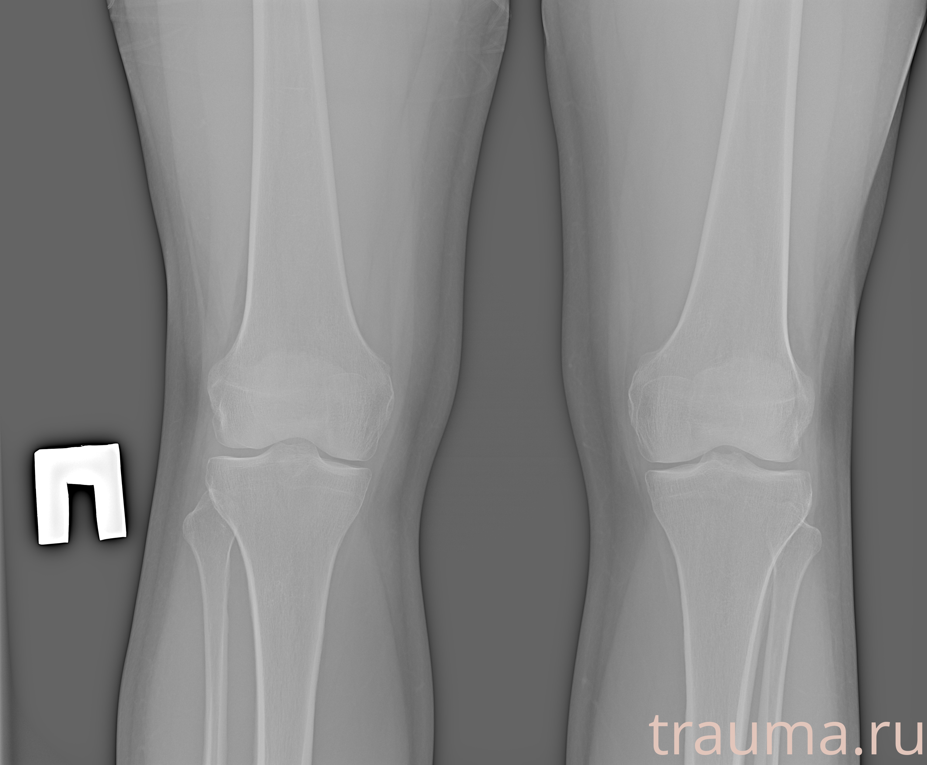 Рентген на дому: по вашему адресу приезжает врач-рентгенолог, травматолог-ортопед с мобильным рентгеновским аппаратом, проводит диагностику травмы или заболевания, делает необходимые рентгенограммы, дает рекомендации по дальнейшему лечению. Получить качественные снимки в домашних условиях возможно благодаря уникальной методике, разработанной МосРентген Центром для института  Склифосовского