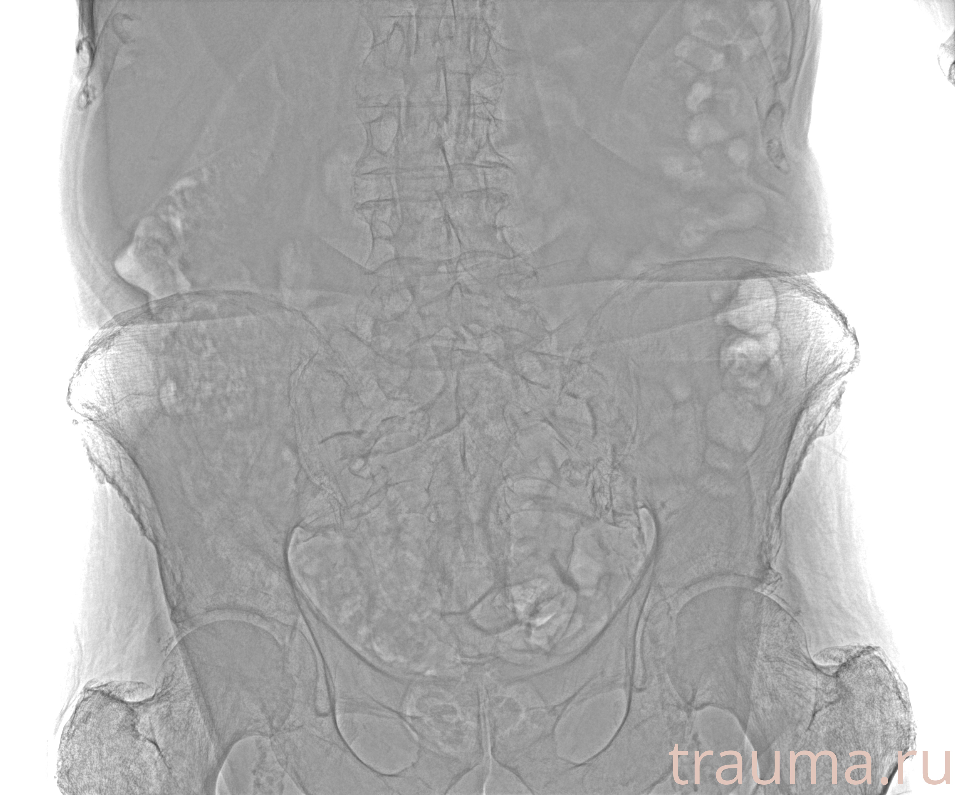 Рентген на дому: по вашему адресу приезжает врач-рентгенолог, травматолог-ортопед с мобильным рентгеновским аппаратом, проводит диагностику травмы или заболевания, делает необходимые рентгенограммы, дает рекомендации по дальнейшему лечению. Получить качественные снимки в домашних условиях возможно благодаря уникальной методике, разработанной МосРентген Центром для института  Склифосовского