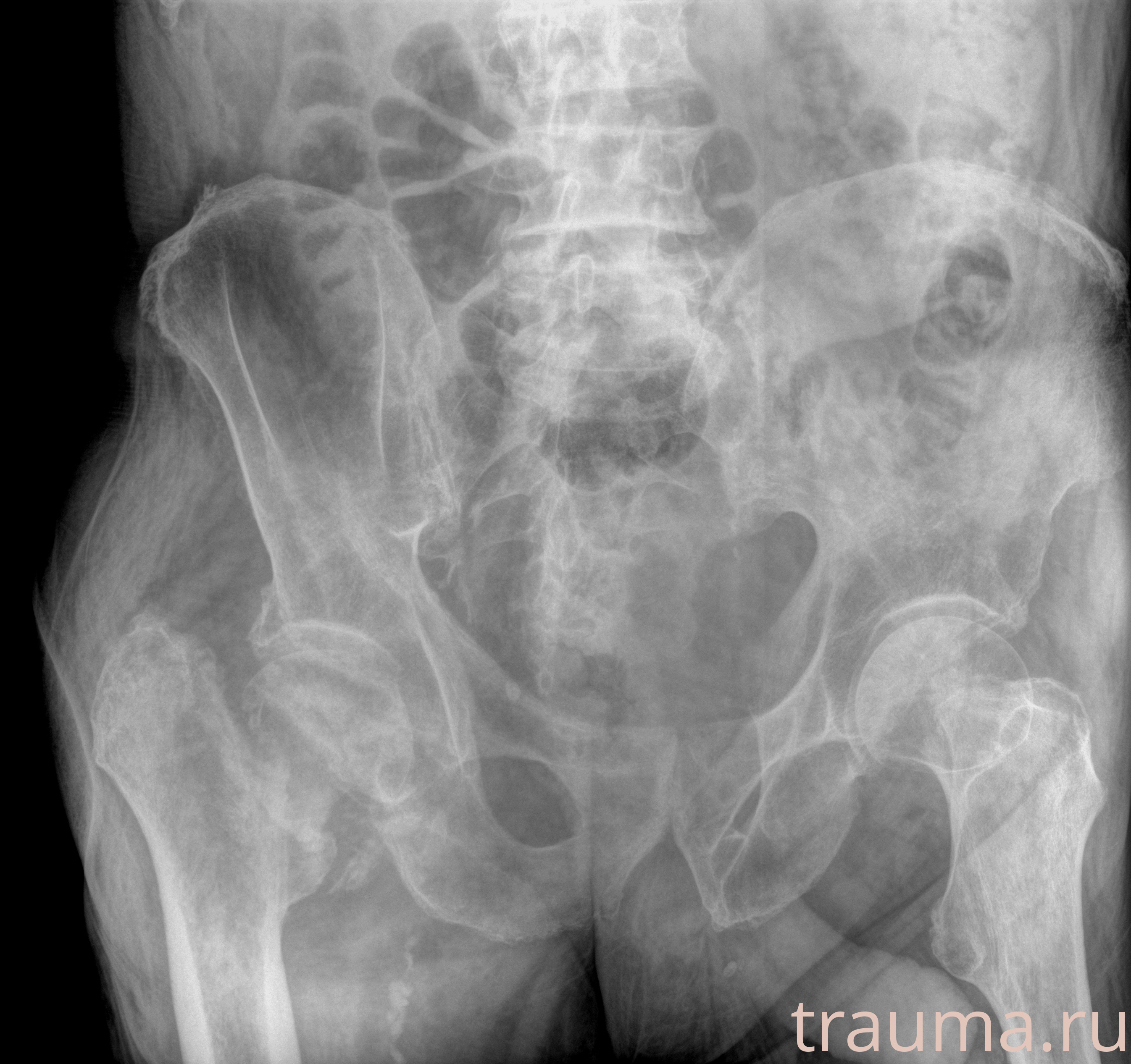 Рентген на дому: по вашему адресу приезжает врач-рентгенолог, травматолог-ортопед с мобильным рентгеновским аппаратом, проводит диагностику травмы или заболевания, делает необходимые рентгенограммы, дает рекомендации по дальнейшему лечению. Получить качественные снимки в домашних условиях возможно благодаря уникальной методике, разработанной МосРентген Центром для института  Склифосовского