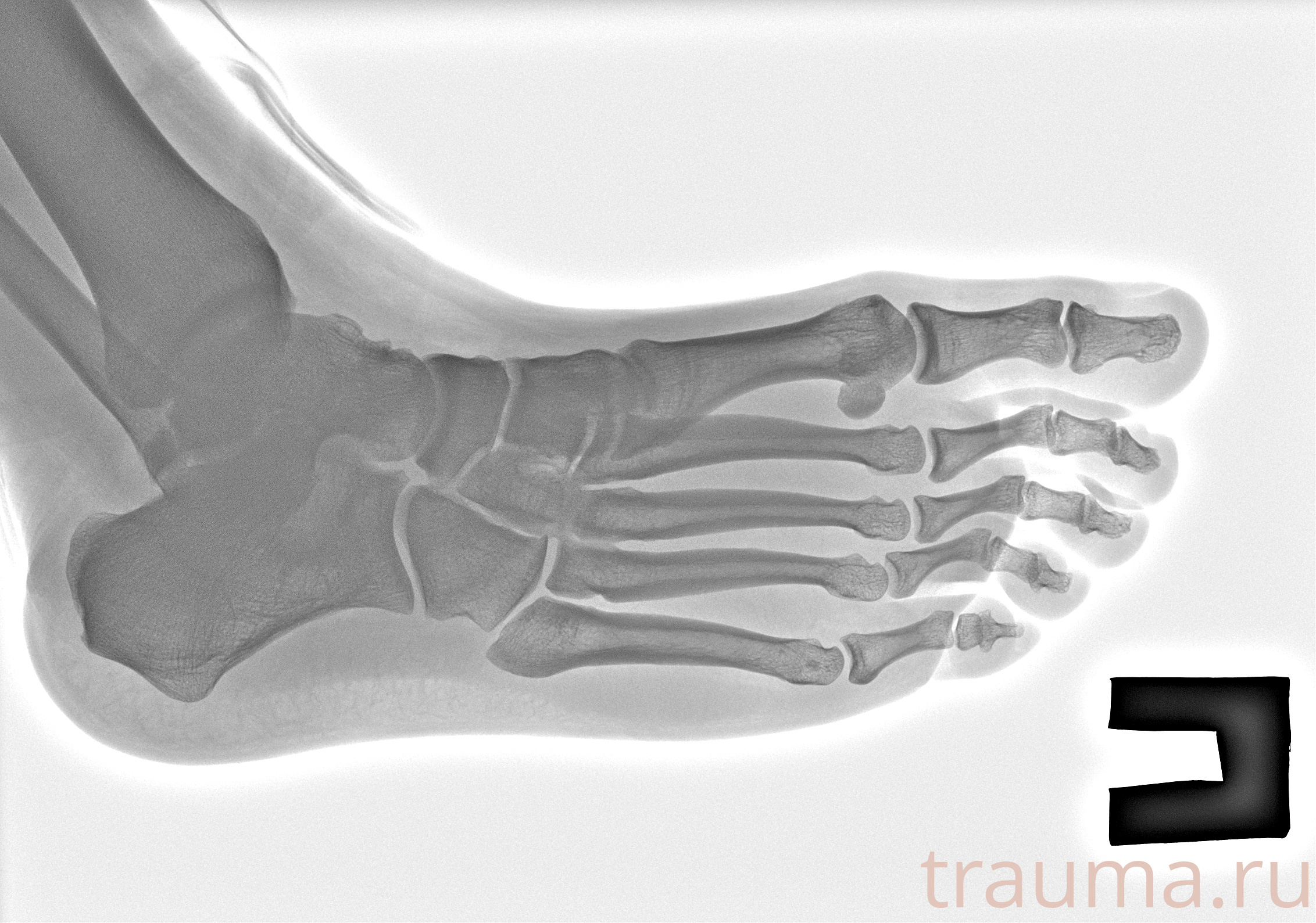 Рентген на дому: по вашему адресу приезжает врач-рентгенолог, травматолог-ортопед с мобильным рентгеновским аппаратом, проводит диагностику травмы или заболевания, делает необходимые рентгенограммы, дает рекомендации по дальнейшему лечению. Получить качественные снимки в домашних условиях возможно благодаря уникальной методике, разработанной МосРентген Центром для института  Склифосовского