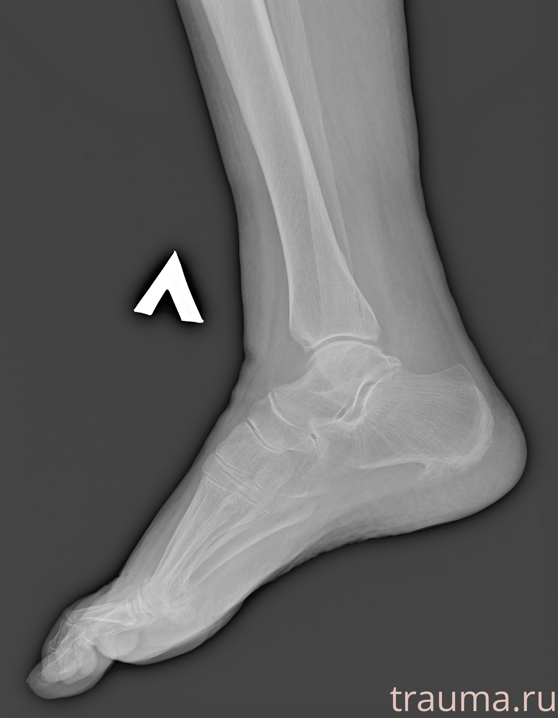 Рентген на дому: по вашему адресу приезжает врач-рентгенолог, травматолог-ортопед с мобильным рентгеновским аппаратом, проводит диагностику травмы или заболевания, делает необходимые рентгенограммы, дает рекомендации по дальнейшему лечению. Получить качественные снимки в домашних условиях возможно благодаря уникальной методике, разработанной МосРентген Центром для института  Склифосовского