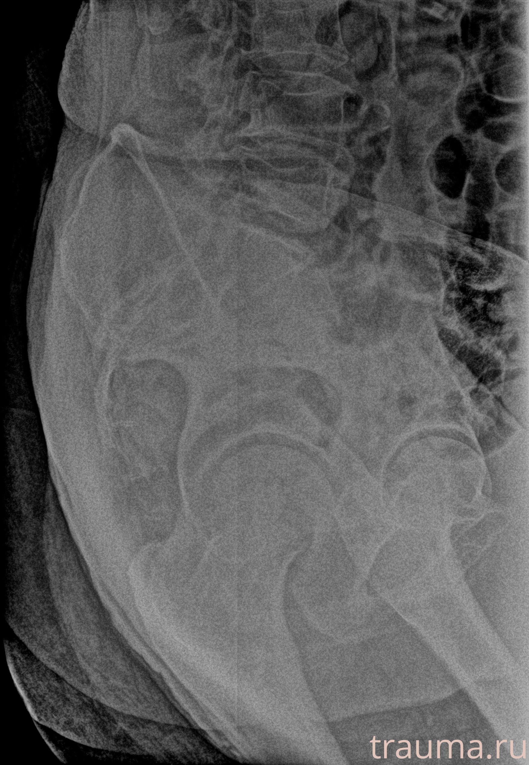 Рентген на дому: по вашему адресу приезжает врач-рентгенолог, травматолог-ортопед с мобильным рентгеновским аппаратом, проводит диагностику травмы или заболевания, делает необходимые рентгенограммы, дает рекомендации по дальнейшему лечению. Получить качественные снимки в домашних условиях возможно благодаря уникальной методике, разработанной МосРентген Центром для института  Склифосовского