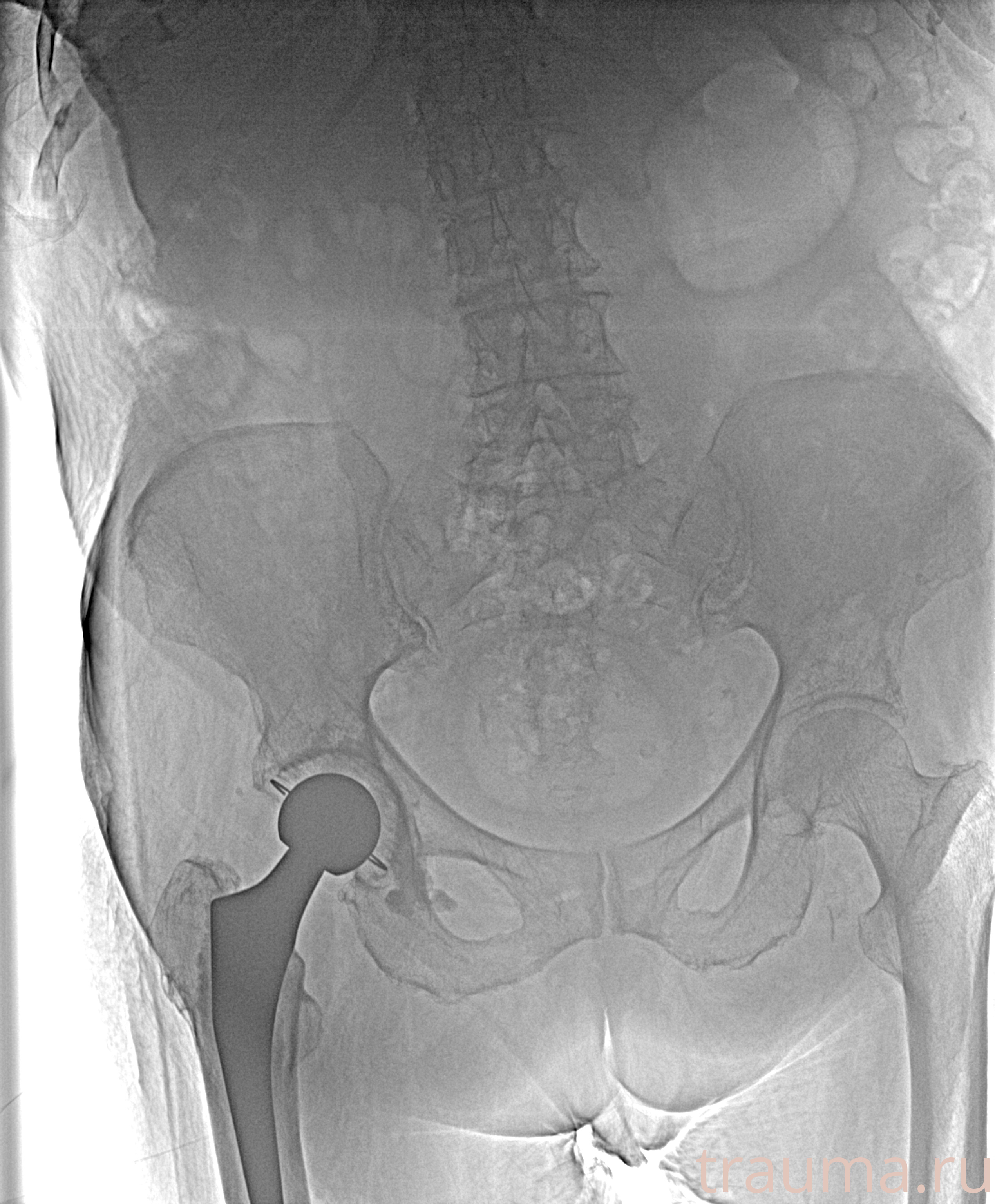 Рентген на дому: по вашему адресу приезжает врач-рентгенолог, травматолог-ортопед с мобильным рентгеновским аппаратом, проводит диагностику травмы или заболевания, делает необходимые рентгенограммы, дает рекомендации по дальнейшему лечению. Получить качественные снимки в домашних условиях возможно благодаря уникальной методике, разработанной МосРентген Центром для института  Склифосовского